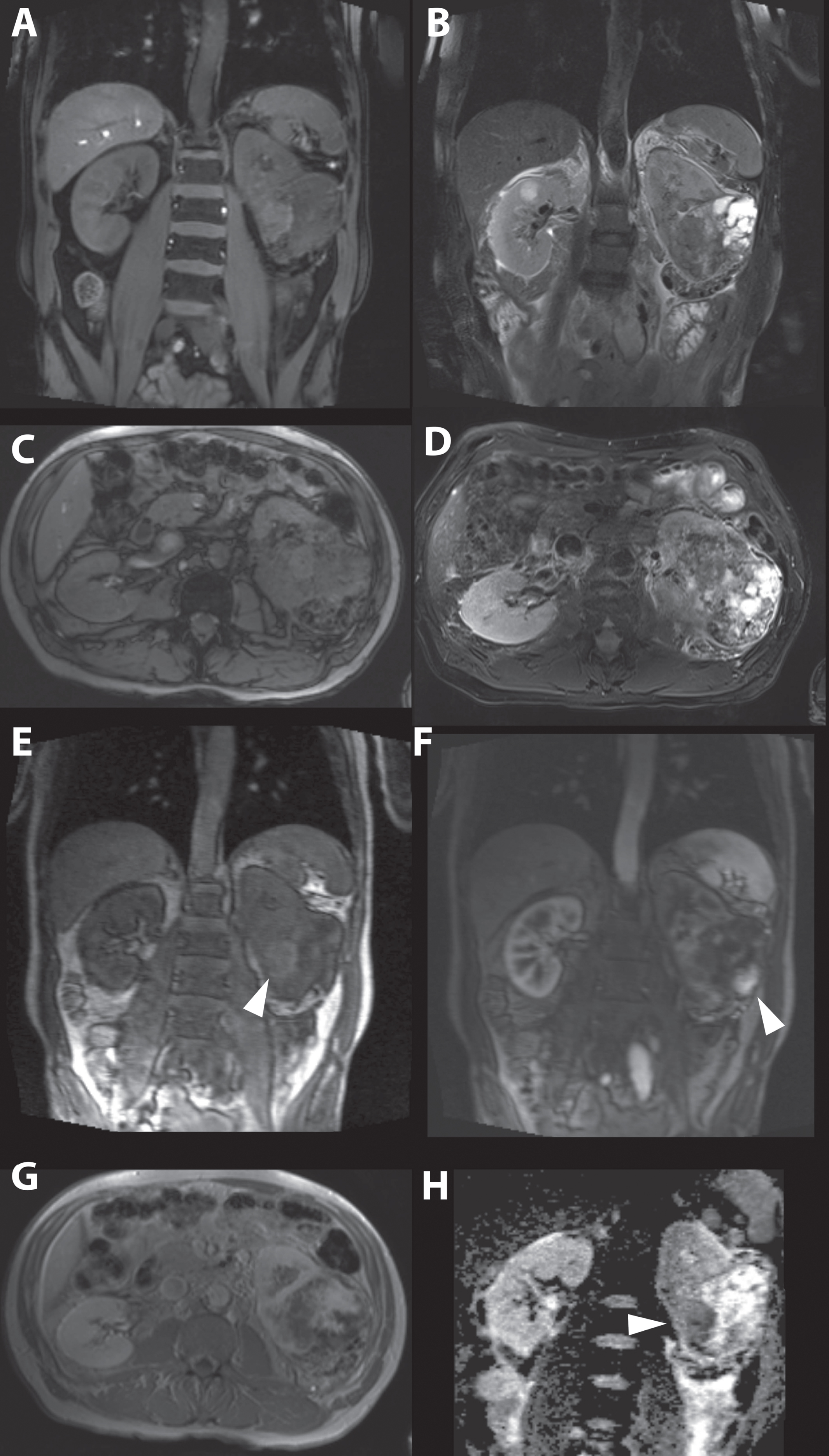 A 63-year-old women was referred for a renal mass detected during analysis of hematuria. Magnetic resonance imaging showed a generally isointense tumor on T1-weighted imaging (A and C), and heterogeneous mainly hypertintense signal intensity on T2-weighted imaging (B and D) consisting of a mixture of tumor and cystic areas and areas with necrosis. Early enhancement is seen in solid parts of the tumor more centrally located. (E) In a later phase the solid parts in the peripheral tumor also enhanced strongly. (F and G). The apparent diffusion coefficient (ADC) map showed diffusion restriction mainly in the more central and solid part of the tumor (H). Consistent with the highly suggestive findings of the MRI, pathology report after open radical nephrectomy showed a 90 mm large Furhman grade III, clear cell renal cell carcinoma.