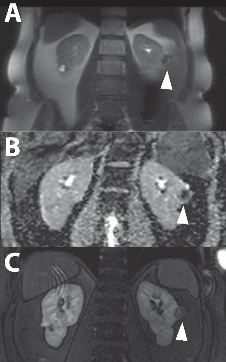 A 49-year-old women was referred for work-up of an incidentaloma of the left kidney found on ultrasound that was performed for progressive renal function impairment. T2-weighted fat suppressed magnetic resonance images acquired in the coronal plane showed an inhomogeneous renal tumor (marked with white arrow head) with predominantly low signal intensities. (A) The apparent diffusion coefficient map calculated from diffusion-weighted sequences using b-values of 50, 400, and 800 showed mild diffusion restriction. (B) The enhancement pattern was very slow, with only mild enhancement 120 seconds after administration of gadolinium-based contrast agent. (C) The patient was treated with percutaneous image-guided cryoablation. Biopsy specimens taken during the procedure showed a type 2 papillary renal cell carcinoma.