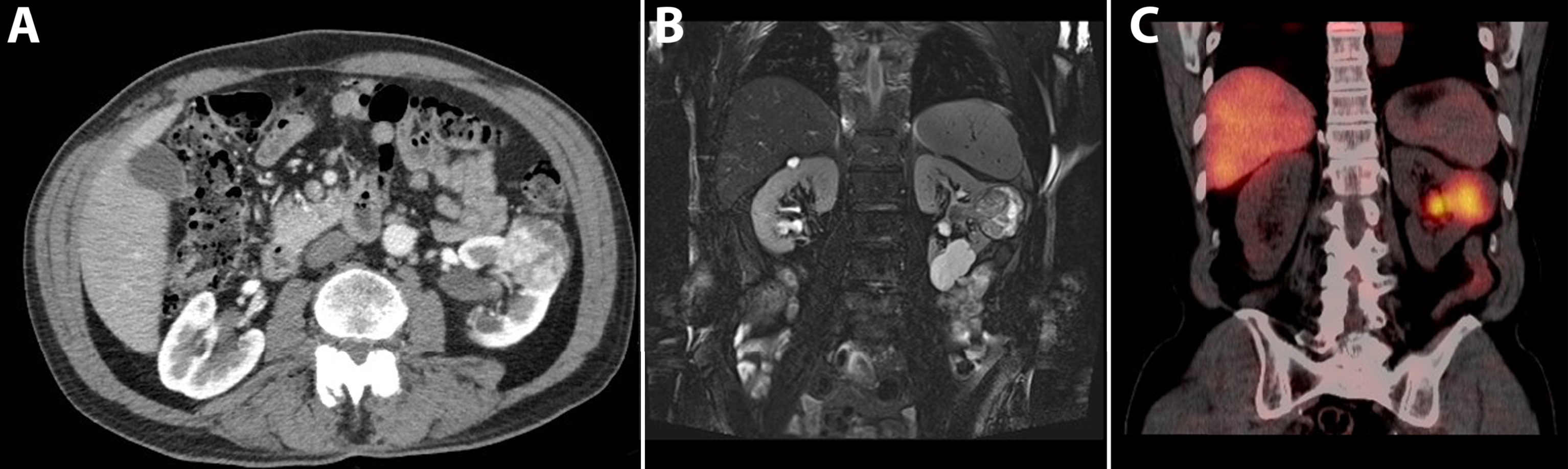 A 74-year-old male patient was evaluated for flank pain and hematuria. A screening ultrasound showed a hypervascular and hyperechoic renal mass of left kidney. A 3-phase CT scan showed an interlobular heterogeneous mass with a maximum diameter of 56 mm in the left renal cortex. Avid enhancement of the solid parts is seen in the corticomedullary phase, especially in the solid tumor parts, making this tumor suggestive for renal cell carcinoma.(A) An additional MRI with T2-weighted fat saturated sequences acquired in the coronal plane showed a heterogeneous renal mass with growth towards the renal pelvis. Note the simple cysts in the lower pole. (B) Additional SPECT/CT 5 days after administration of 111-Indium-Girentuximab shows targeting of the renal tumor making a clear cell subtype highly likely. A second hot spot in the renal pelvis was noted. (C) Histopathology after laparoscopic radical nephrectomy confirmed the diagnosis of a 50 mm large, Furhman grade 3, clear cell renal cell carcinoma.