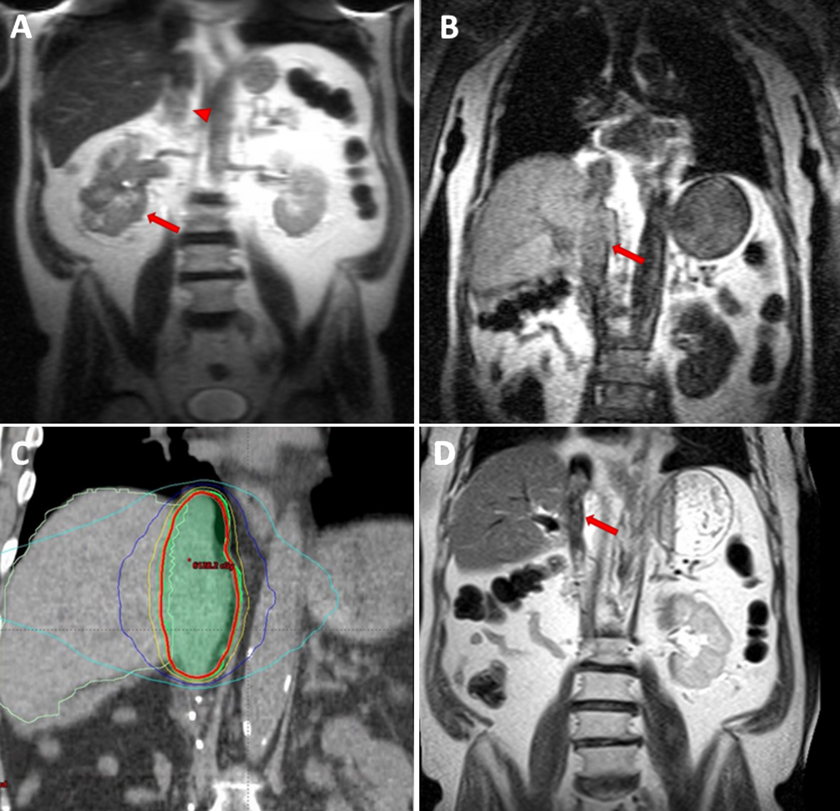 MRI images of a 74 y/o man with right renal mass (arrow) and tumor thrombus (arrow head) extending to the right atrium (level IV) (A). After radical nephrectomy and thrombectomy, IVC tumor thrombus recurred (arrow) (B). SBRT (5×10 Gy) was delivered to the thrombus area – CT images demonstrate radiation planning (red contour representing the 95% iso-dose line) (C). Follow-up MRI, 16 months after completion of SBRT showing a decrease in IVC tumor thrombus size and enhancement (arrow) (D).
