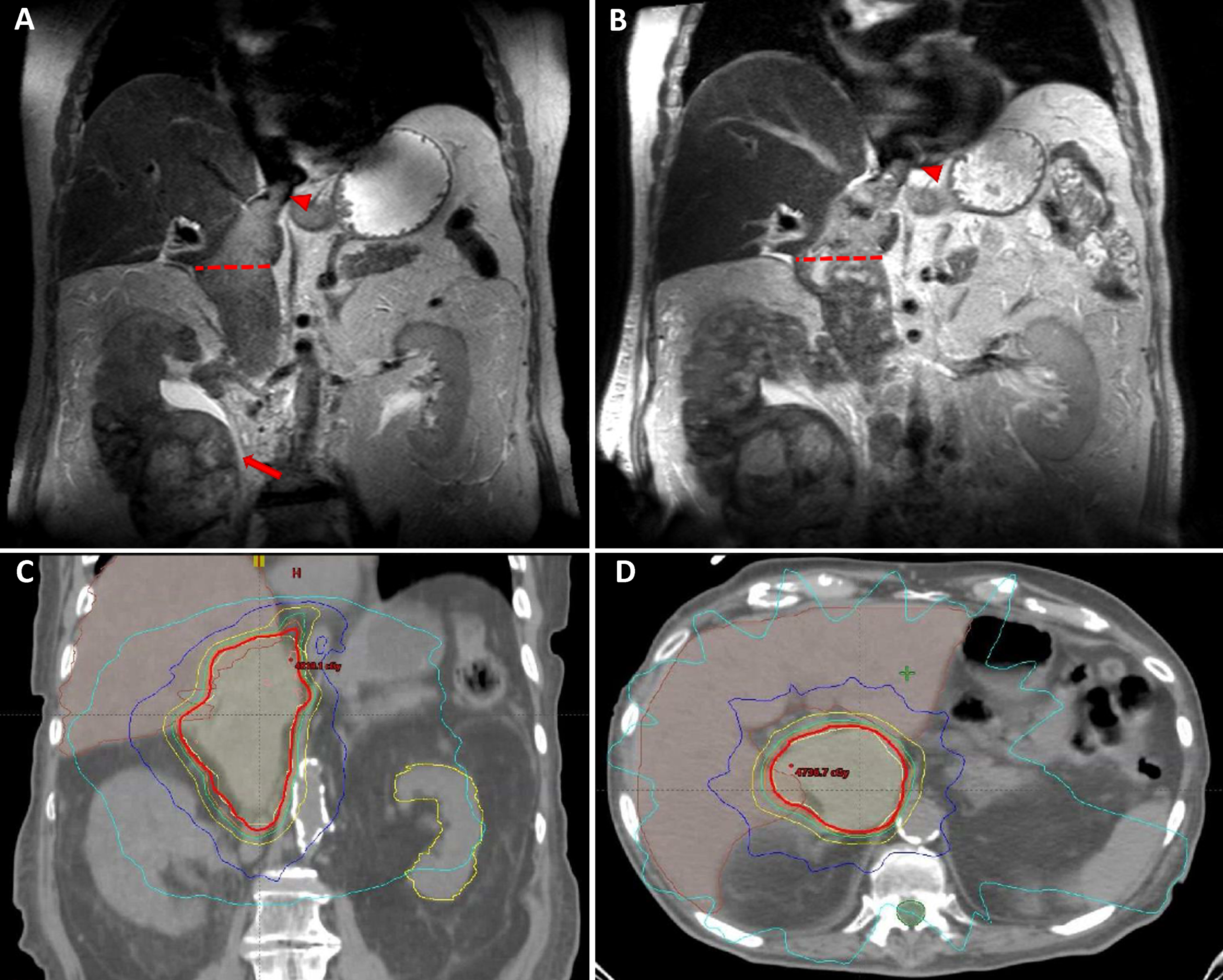 MRI images of an 83 y/o man with right renal mass (arrow) and level IV tumor thrombus (arrow head), with a maximal diameter of 49 mm (dotted line) (A). Progressive increase in tumor thrombus size and enhancement, measuring 57 mm (dotted line and arrow head) (B). SBRT (5×9 Gy) was planned covering the thrombus area – CT images demonstrate radiation planning (red contour representing the 95% iso-dose line) (C-D).