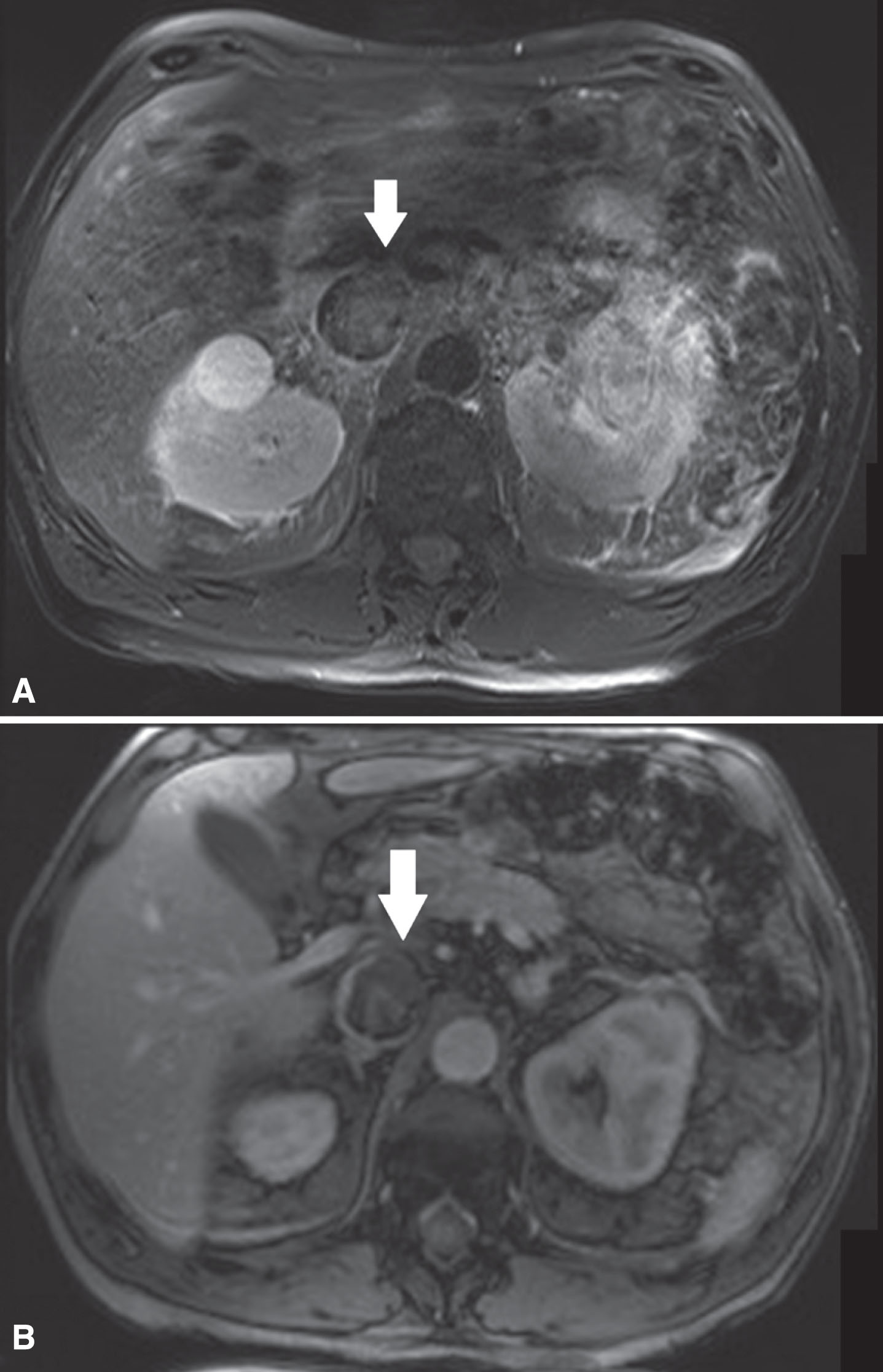 (A) In this patient with a left sided tumor and level 2 thrombus, the T2-weighted MR images showed loss of high signal intensity at the medial/ventral side of the vena cava wall (white arrow) suspicious for IVC wall invasion. (B) The corresponding DCE sequence showed evident loss of vein wall signal (white arrow) supporting the suggestion of IVC wall invasion. Surgical findings confirmed medial/ventral IVC wall invasion.