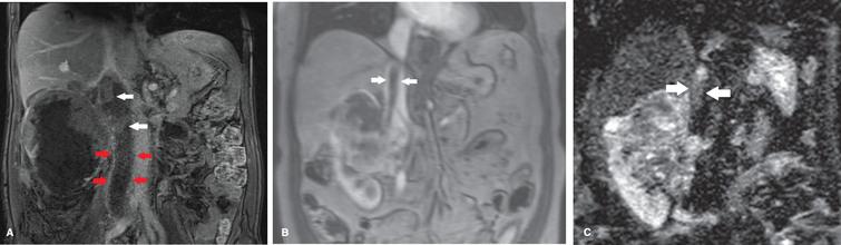(A) In a patient with a right sided tumor with a level 2 thrombus (including occlusion of the iliac veins) the DCE sequence showed no enhancement of the thrombus caudal of the renal veins (between 4 most caudal arrows). Clear heterogeneous enhancement of the tumor thrombus is seen at more cranial level (white arrows) suggestive for vital tumor. (B) In contrast, in this patient with a level 3 thrombus and right sided tumor, no contrast enhancement of the thrombus is seen (between white arrows). (C) On the DW-MRI sequence clear diffusion restriction of the thrombus is seen suggestive for vital tumor (between white arrows). Histopathology confirmed the finding of vital tumor in the thrombus.