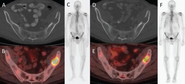 66-year-old man with metastatic renal cell carcinoma. (A) CT and (B) PET/CT at baseline show an FDG-avid lytic lesion in the left iliac bone. (C) Anterior whole-body bone scan does not show the lesion. (D) CT at 2 cycles shows an unchanged lytic lesion, (E) PET/CT shows >50% decrease in SUVmax, (F) and anterior whole-body bone scan again does not show the lesion.
