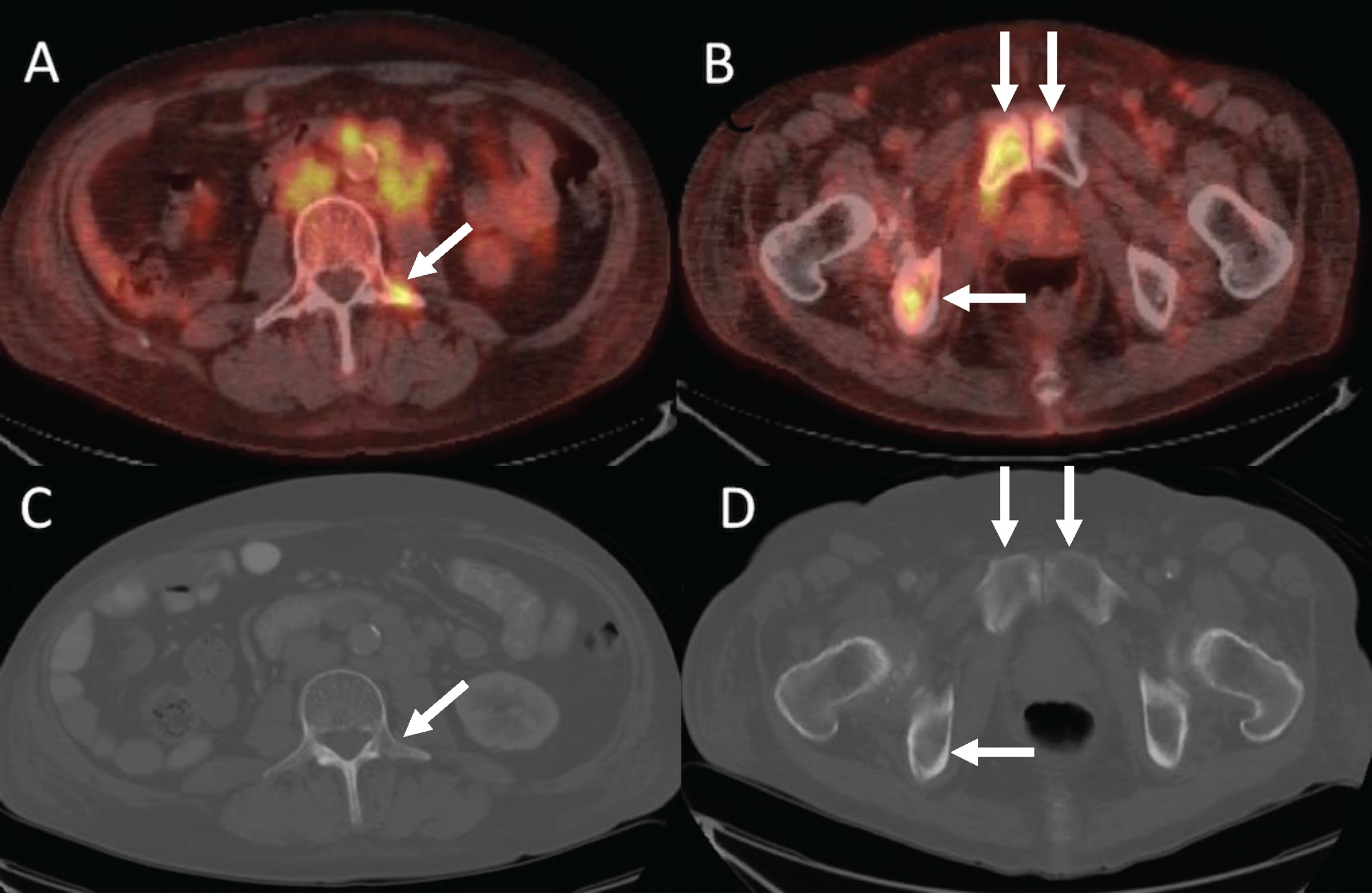 42-year-old man with metastatic renal cell carcinoma. Baseline PET/CT imaging shows osseous metastases at (A) L3 (arrow) and (B) in the pubic bones (arrows). CT does not show the metastatic lesions at L3 (C, arrow) or in the pubic bones (D, arrows).