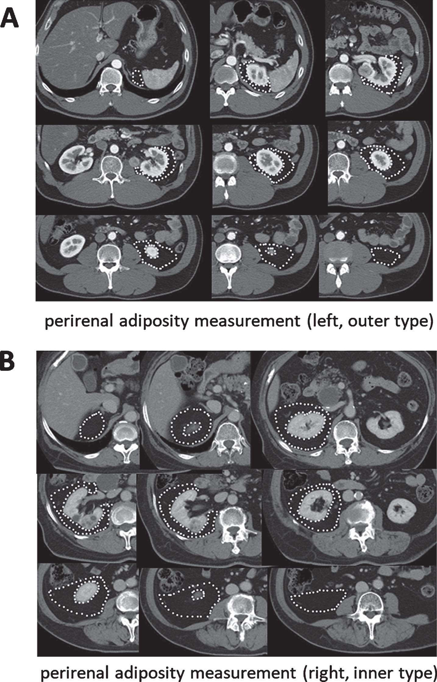 Measurement of fat area using 5 mm CT slices and SYNAPSE VINCENT® software. (A) Perirenal adiposity measurement (left side, RCC is outer type). (B) Perirenal adiposity measurement (right side, RCC is inner type).