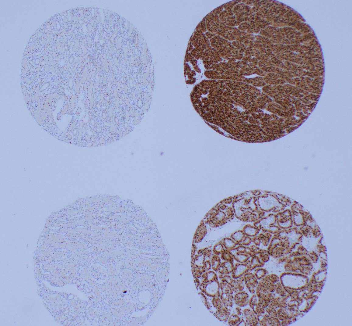 Examples of immunohistochemistry staining of punched tissue specimen with the Cyclin D1 antibody demonstrating (A) normal expression, (B) overexpression, (C) normal expression, and (D) overexpression of Cyclin D1.