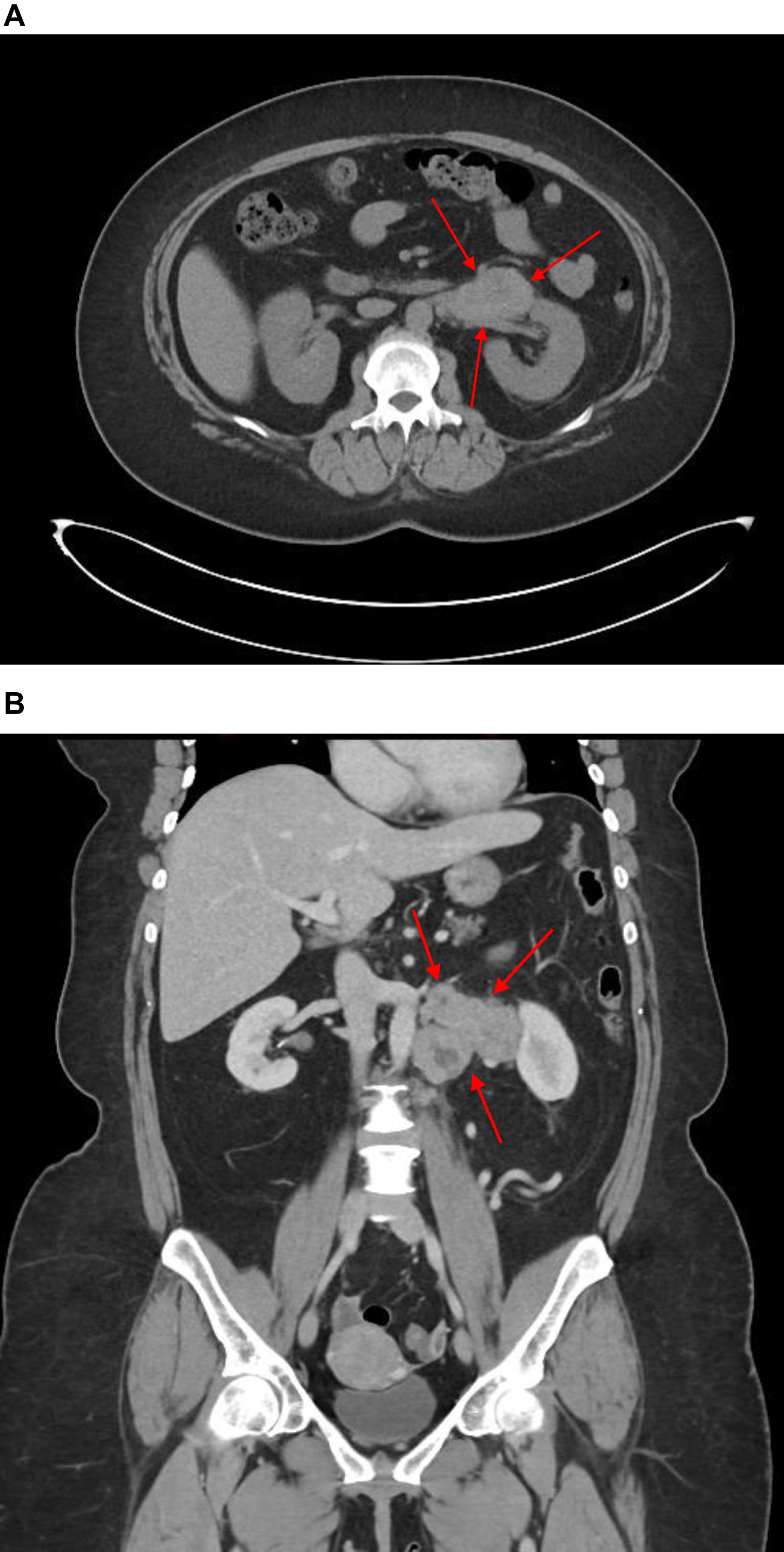 Pre-operative CT scan of left retroperitoneal mass, axial view. B Pre-operative CT scan of left retroperitoneal mass, coronal view. CT scan demonstrates left exophytic pararenal mass with involvement of renal vasculature. As discussed in the text, no clear involvement of the left kidney was evident. Left periaortic lymph node involvement and a normal right kidney can be appreciated.