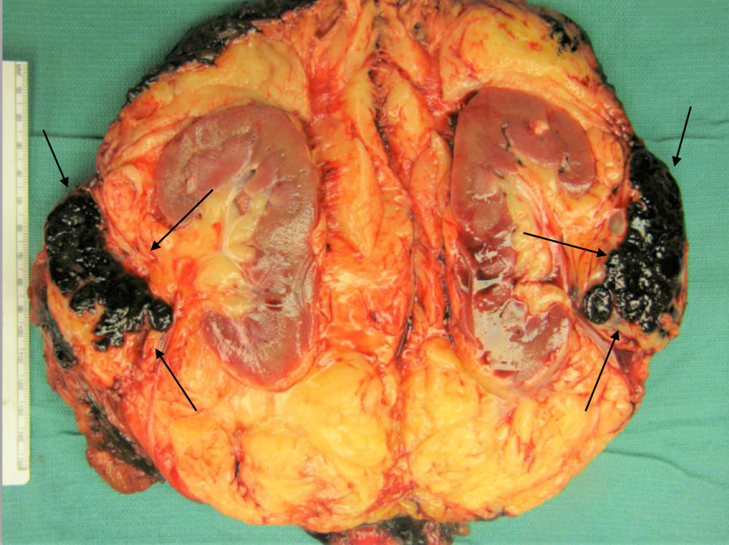 Gross photograph of the renal tumor (black arrows) demonstrating its location within the renal hilar soft tissue, outside the renal parenchyma. Examination of the specimen demonstrated no involvement the kidney, which was otherwise unremarkable. Multiple sections to demonstrate the relationship of tumor to renal parenchyma were submitted and confirmed the carcinoma did not involve the renal parenchyma.