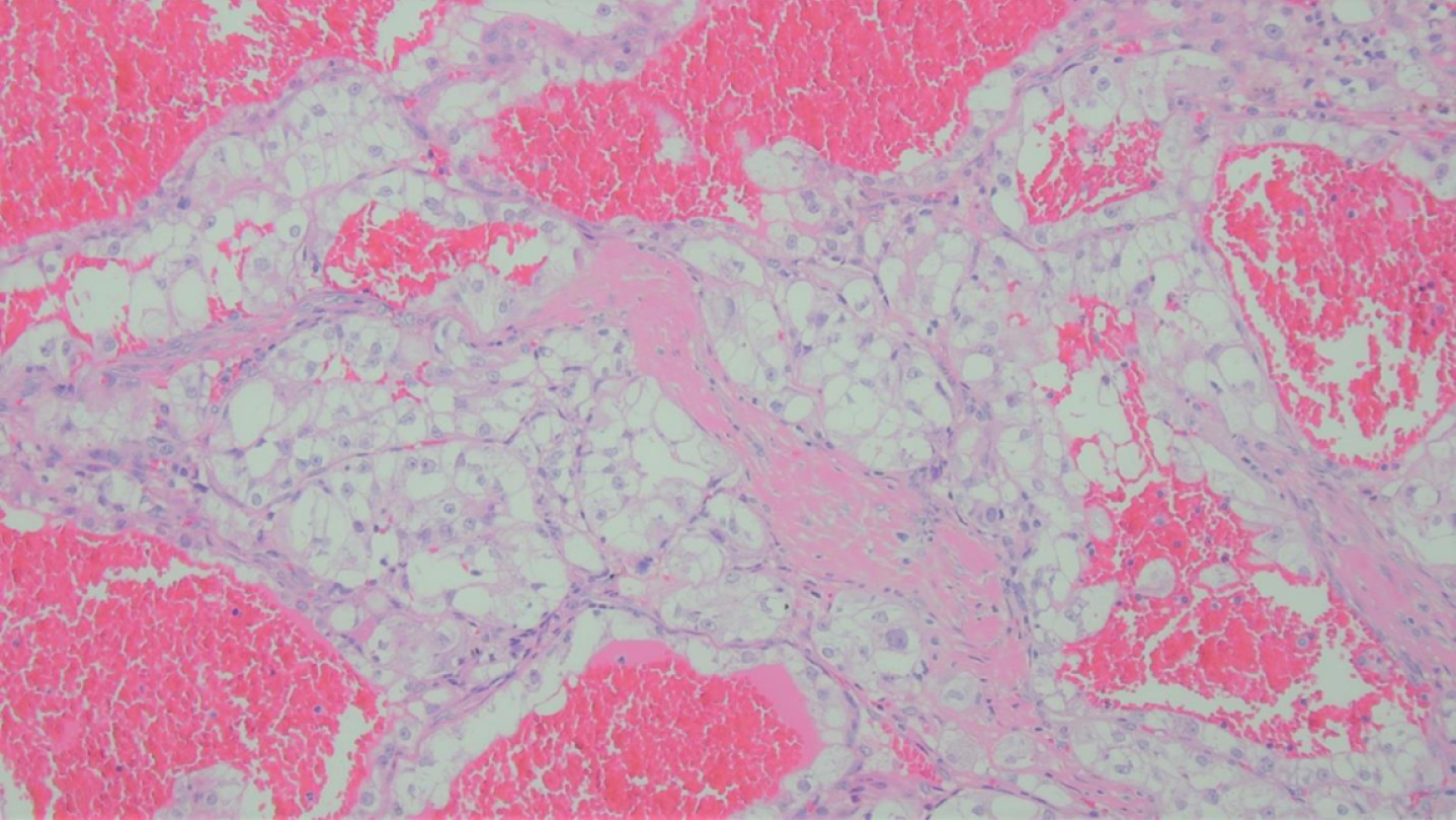 Hematoxylin and Eosin Stain showed a tumor composed of clear cells arranged in nests, surrounded by delicate vasculature, and cysts engorged with blood.