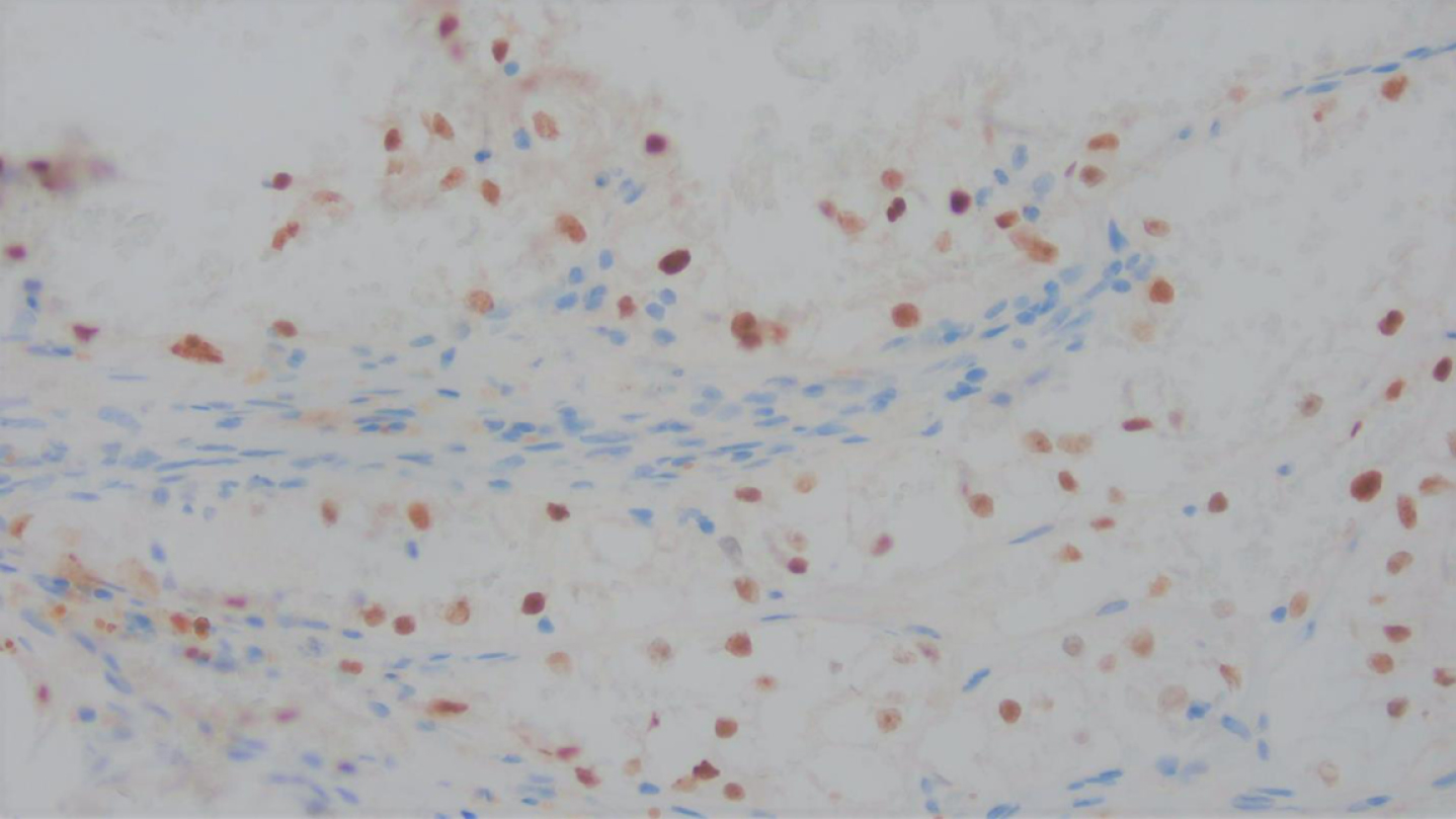 The tumor was positive for PAX-8, a nuclear stain confirming renal origin.