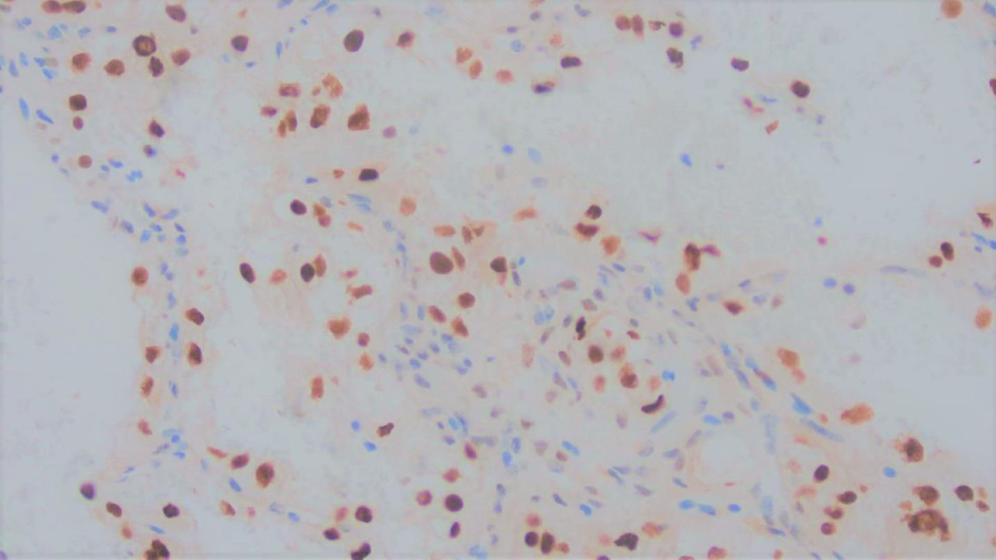 Immunohistochemical stain for TFE3 showed nuclear positivity, in keeping with an equivocal result necessitating the exclusion of TFE3 associated renal cell carcinoma.