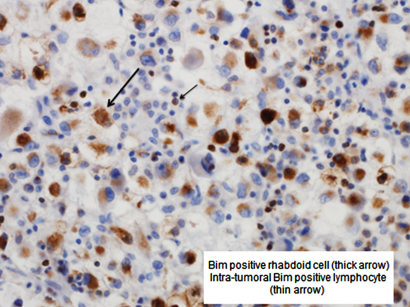 Bim positive rhabdoid cell (thick arrow) and intra-tumoral Bim positive lymphocyte (thin arrow).