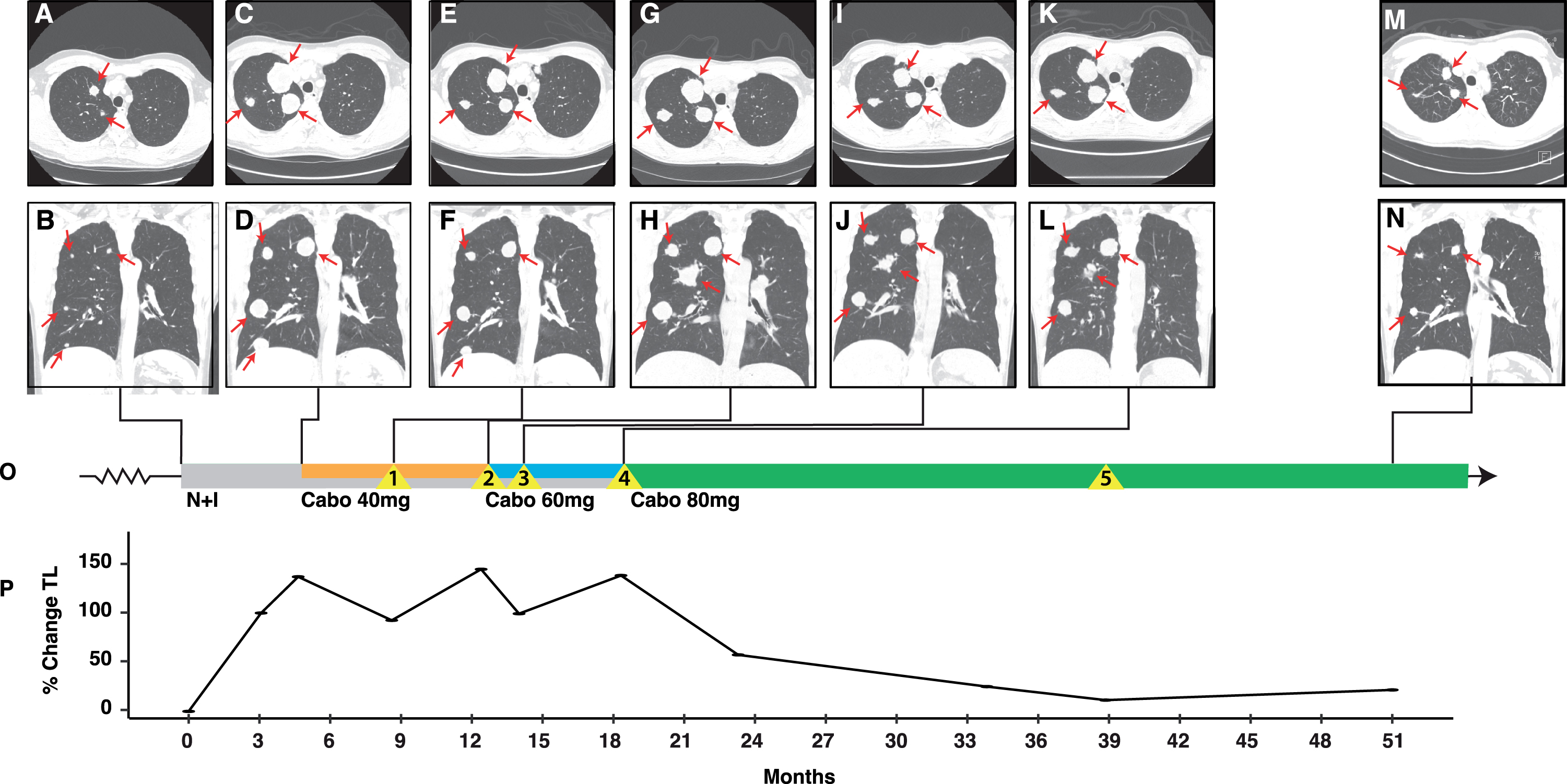 Integrated clinical overview containing key images, tumor burden, and treatment history for patient case 2. Representative lung lesions (red arrows) at key timepoints during the patient’s disease course including: At the start of N + I (A and B); at progression following 4 cycles of N + I with the addition of cabozantinib 40 mg to nivolumab (C and D); at time of initial response to nivolumab/cabozantinib 40 mg (E and F); at time of progression with new brain lesions and transition to nivolumab/cabozantinib 60 mg (G and H); after initial response to nivolumab/cabozantinib 60 mg (I and J); at the time of acquired resistance with development of new brain lesion (K and L); and after prolonged therapy on cabozantinib 80 mg (M and N). Radiographic images are integrated into the treatment timeline (O) which depicts systemic therapies (N + I in grey; cabo 40 mg in orange; cabo 60 mg in blue; and cabo 80 mg in green), and clinical events (yellow triangles). The proportional change in tumor burden, reported as the sum of the longest diameters of target lesions is depicted in (P). Events: 1, isolated progression in a gluteal mass which was surgically resected; 2, development of two new brain metastases treated with gamma-knife (GK); 3, isolated progression of two hepatic metastases which were treated with SBRT; 4, new brain metastasis treated with GK; 5, recurrence of resected gluteal metastasis treated with consolidative SBRT. Abbreviations: Cabo, cabozantinib; N + I, nivolumab and ipilimumab; TL, target lesion.
