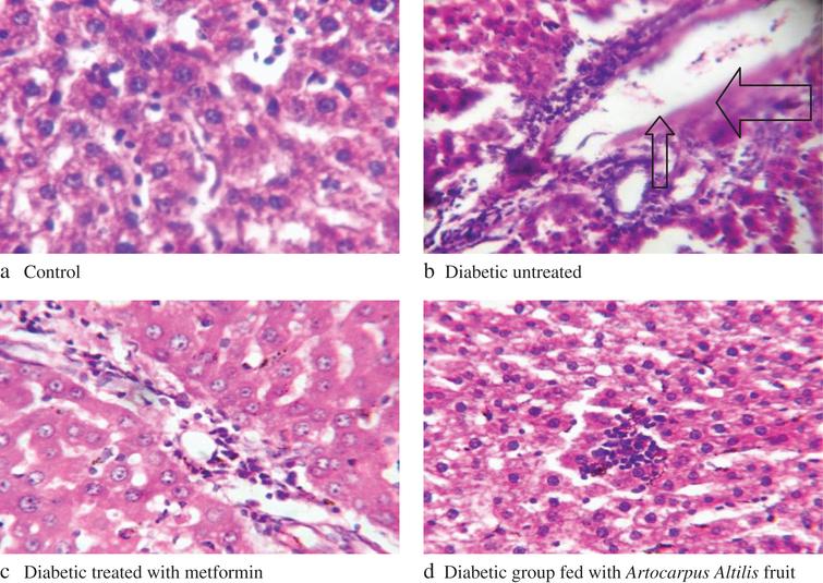 Changes in histology of Alloxan-Induced Diabetic Rats livers. Arrows: shows portal congestion, periportal cellular infiltration, and vacuolar degeneration of hepatocytes.
