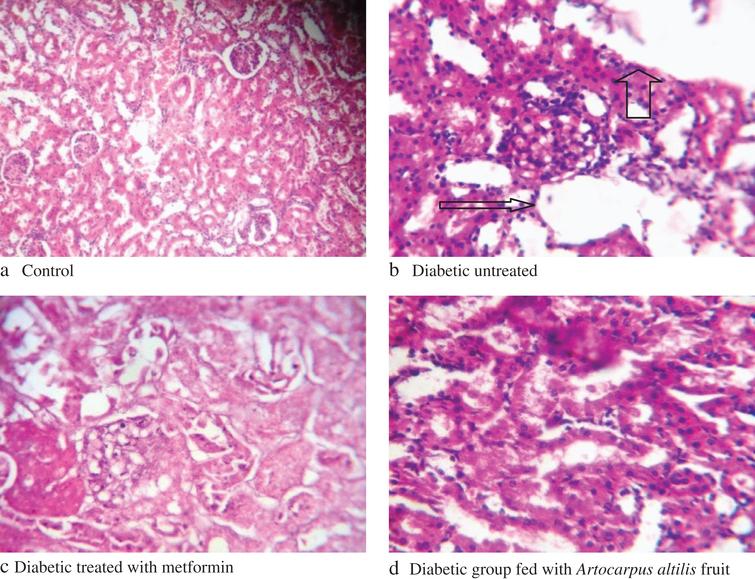 Changes in histology of Alloxan-Induced Diabetic Rats kidneys. Arrows: shows portal congestion, periportal cellular infiltration, and vacuolar degeneration of nephrocytes.