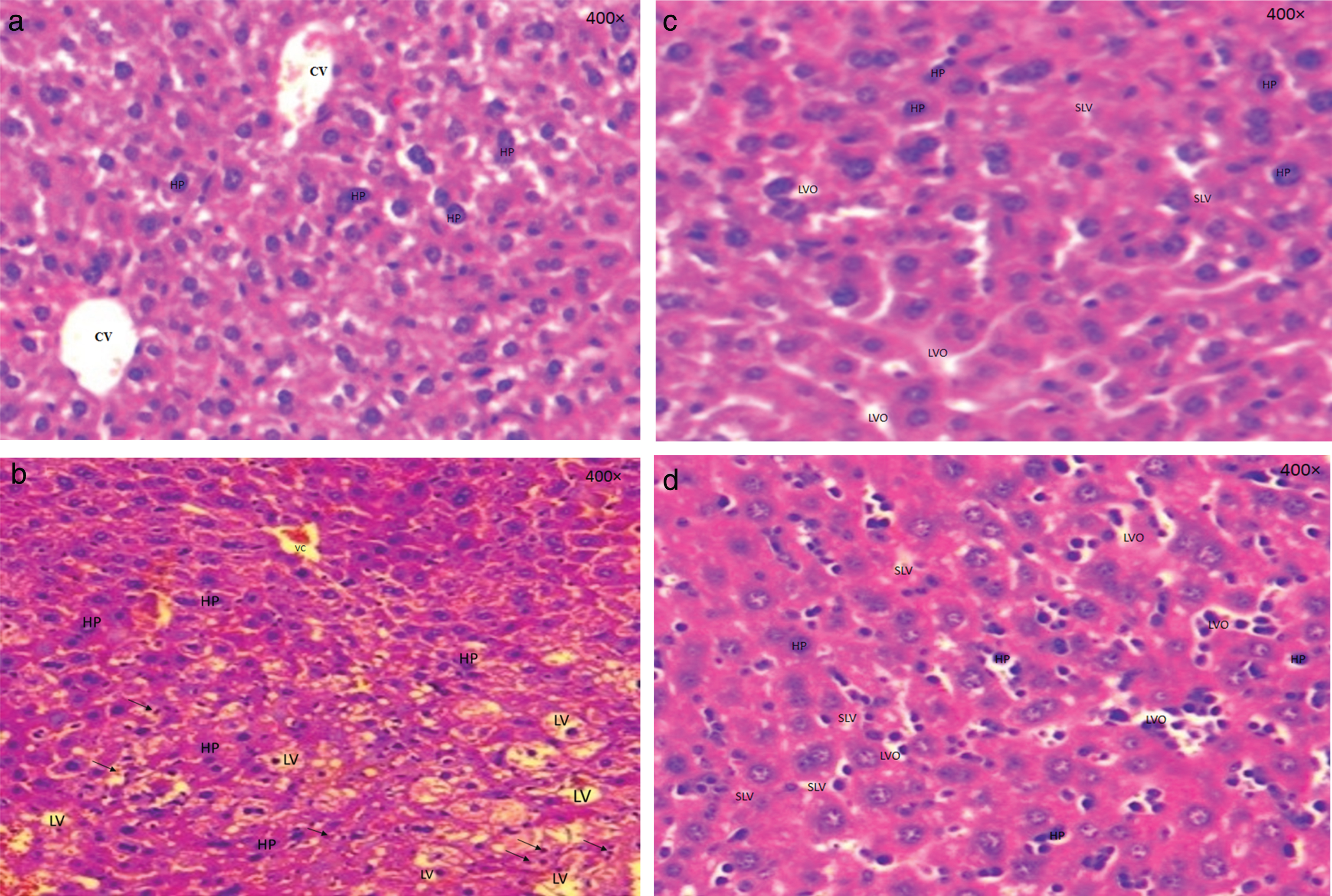 (a) Sectional representations (400×magnification) of untreated liver with hematoxylin/eosin performed after 24 hours of processing. Lot I (normal control). (CV): congestive vein. (b) Sectional representations (400×magnification) of pre-treated, triton-induced hyperlipidaemic mice liver with hematoxylin/eosin performed after 24 hours of processing. Lot II (control hyperlipidaemic) showing a massive distribution of lipids within hepatocytes (HP) which allows intrahepatic provision of these lipids in the form of vacuoles (LV). Presence of an infiltrate with neutrophils (arrows). (c) Sectional representations (400×magnification) of pre-treated, triton-induced hyperlipidaemic and a dose of 300 mg/kg from leaf extracts mice liver with hematoxylin/eosin performed after 24 hours of processing. Lot III showing a small lipid vacuoles (SLV) and others optically (LVO) empty which are present in hepatocytes. (d) Sectional representations (400×magnification) of pre-treated, triton-induced hyperlipidaemic and a dose of 300 mg/kg from twig extracts mice liver with hematoxylin/eosin performed after 24 hours of processing. Lot IV showing a small lipid vacuoles (SLV) and others optically (LVO) empty which are present in hepatocytes.