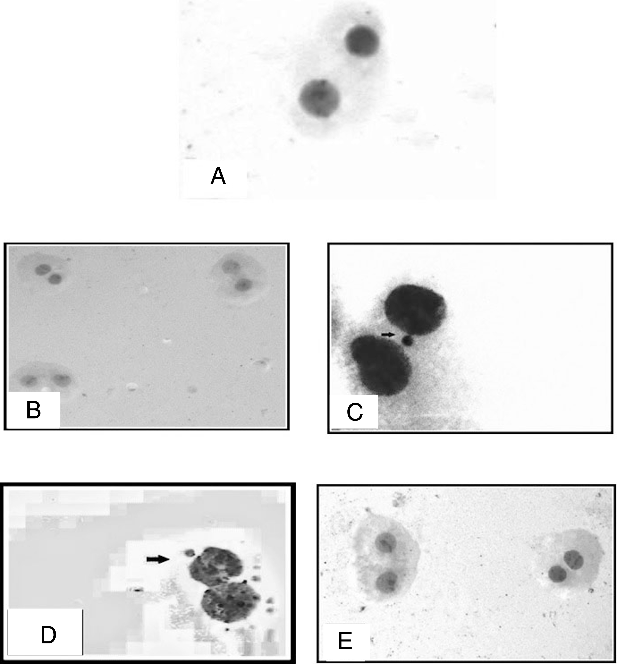 Photomicrographs of HepG2 cells stained by Geimsa stain A: control HepG2 cells B: Cells treated with honey C: Cells treated with residue showing binucleated cell containing micronucleus (arrow) D: Cells treated with ethyl acetate fraction showing binucleated cell containing micronuclei (thick arrow) E: Cells treated with Chloroform- methanol fraction showing multiple binucleated cells without micronuclei. The micronucleus has a similar appearance and intensity to the main nuclei (10×40).