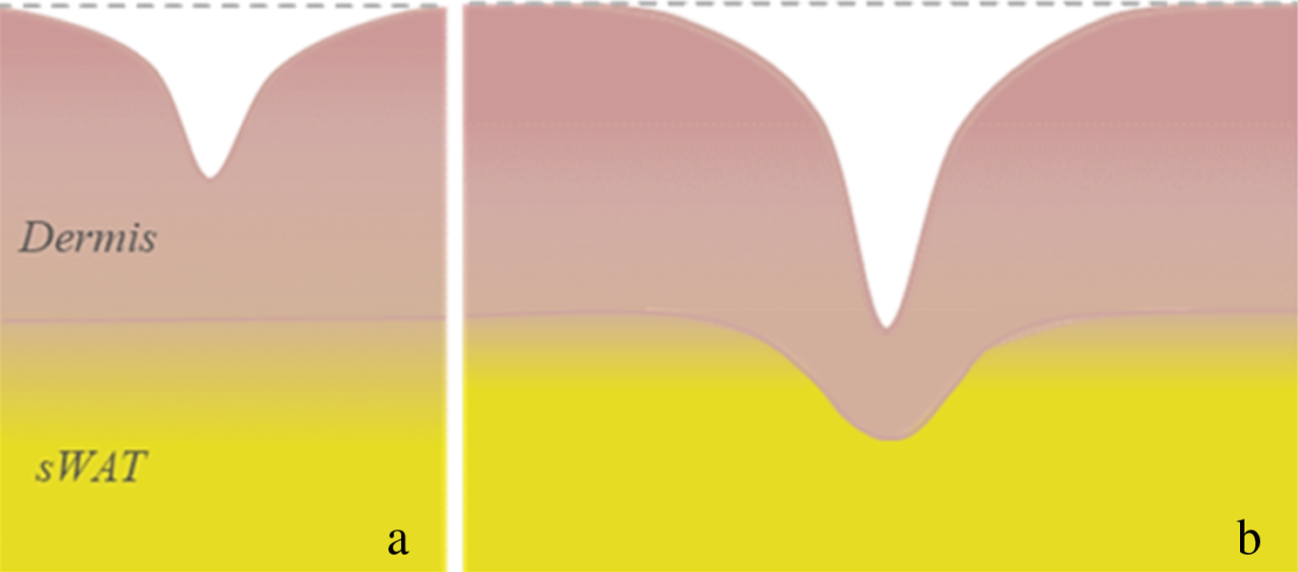 Typical wrinkles in human skin: a – superficial wrinkles; b – deep wrinkles (modified after [26]).