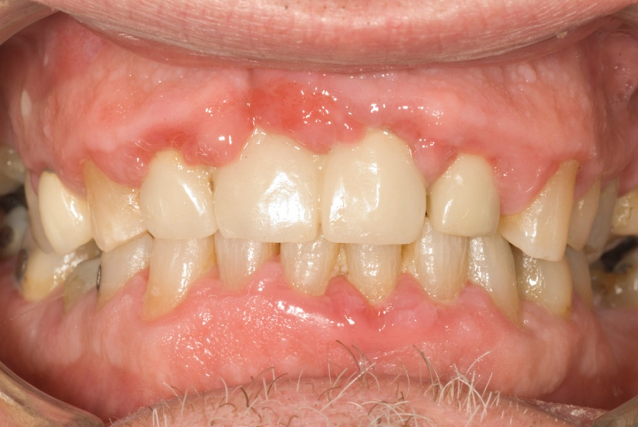 Patient with periodontal disease. Note erythema around gingival margin, loss of interdental papillae, recession and tooth loss associated with this disease (Photo credit: Prof. Anthony Roberts, UCC).