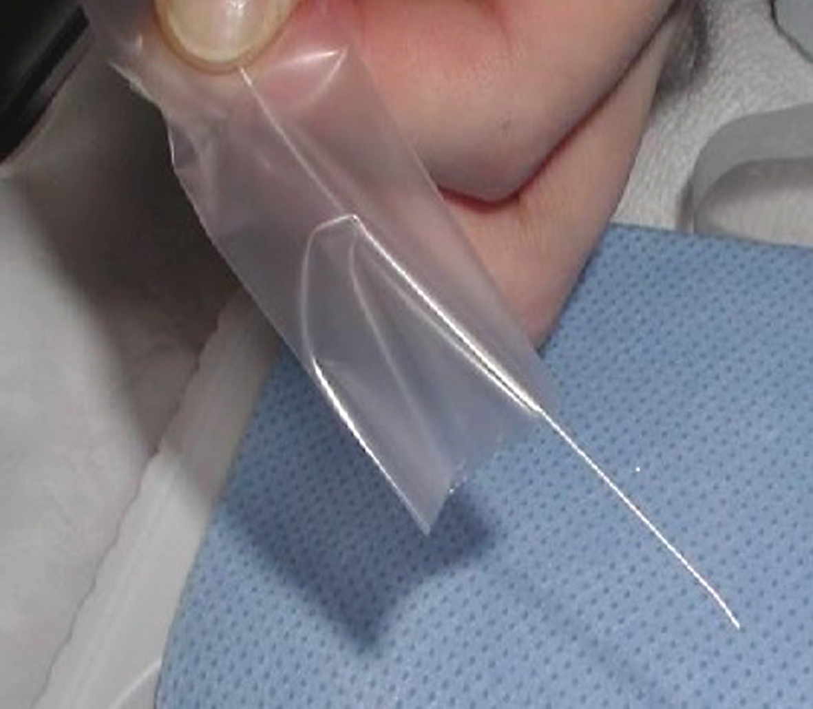 Double lumen catheter (Argyle™).