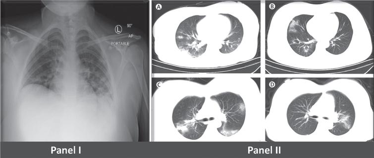 Chest radiograph (Panel A) of COVID positive 18-year-old female patient with non-specific radiographic evidence of bilateral pneumonia. Computerized Tomography (Panel B) from 4 pregnant mothers reveals diffuse reduction in brightness of both lungs and large multiple areas of ground-glass opacities or patchy shadow with an uneven density [29]. [Panel B image has been approved by Lancet Infectious Disease].