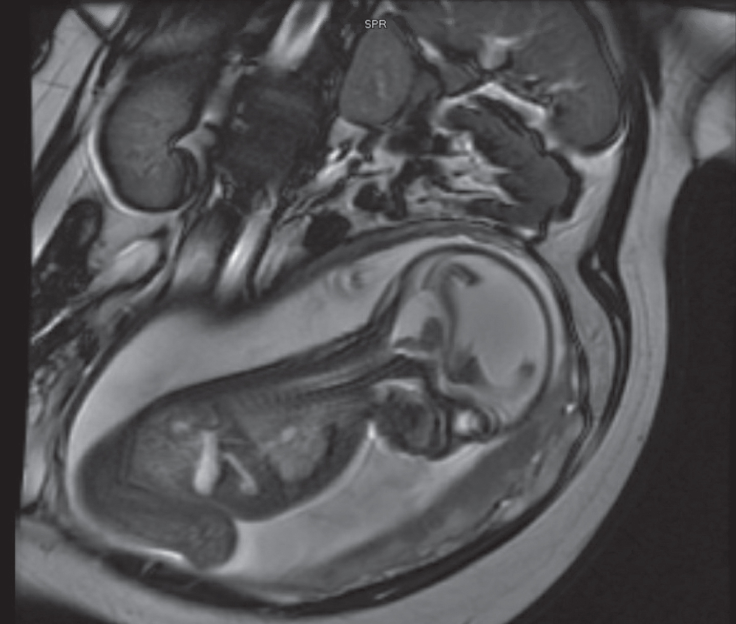 27 weeks fetal MRI showing massive ventriculomegaly, with associated cystic dilatation of posterior fossa consistent with Dandy Walker malformation
