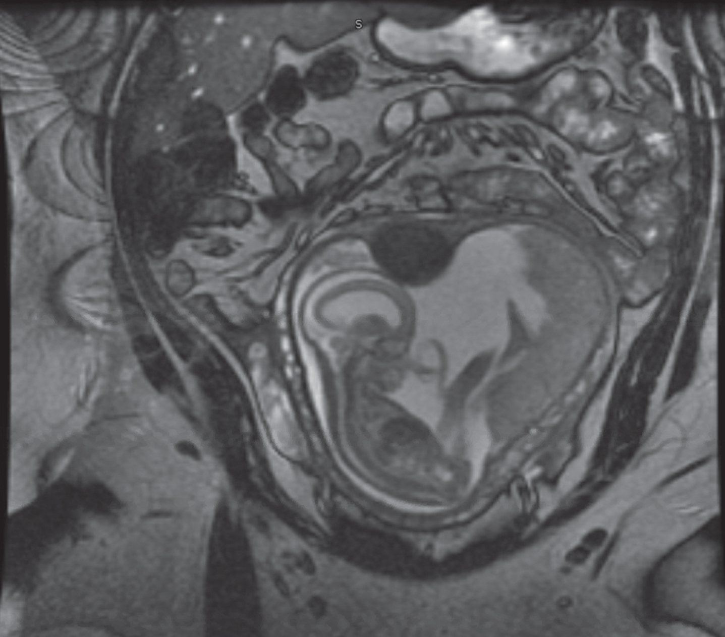 19 weeks old fetal brain MRI showing CAS associated severe ventriculomegaly and cerebellar atrophy