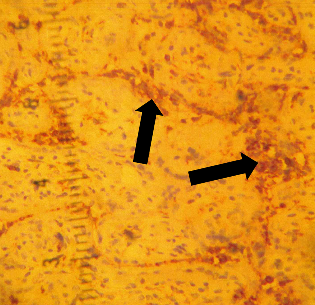 A. Placental histology shows histiocytic intervillositis highlighted by CD68 stain (arrows).