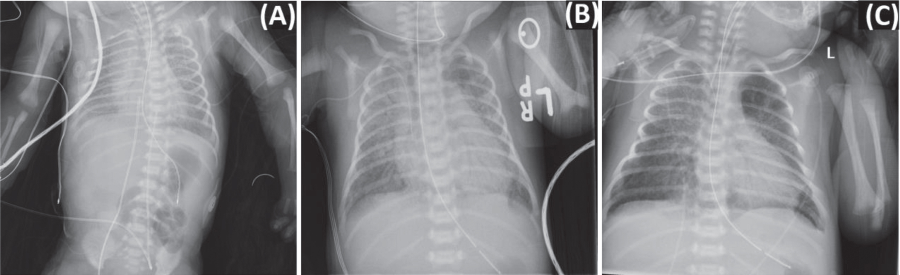 Case report X-ray findings. Chest X-ray revealing coarse interstitial opacities and air bronchograms bilaterally (A). Nine days after birth, chest X-ray revealed bilateral diffuse interstitial infiltrates worse on the right (B). Bilateral opacities and multifocal infiltrates along the right upper lobe persisted on day of life 14 (C).