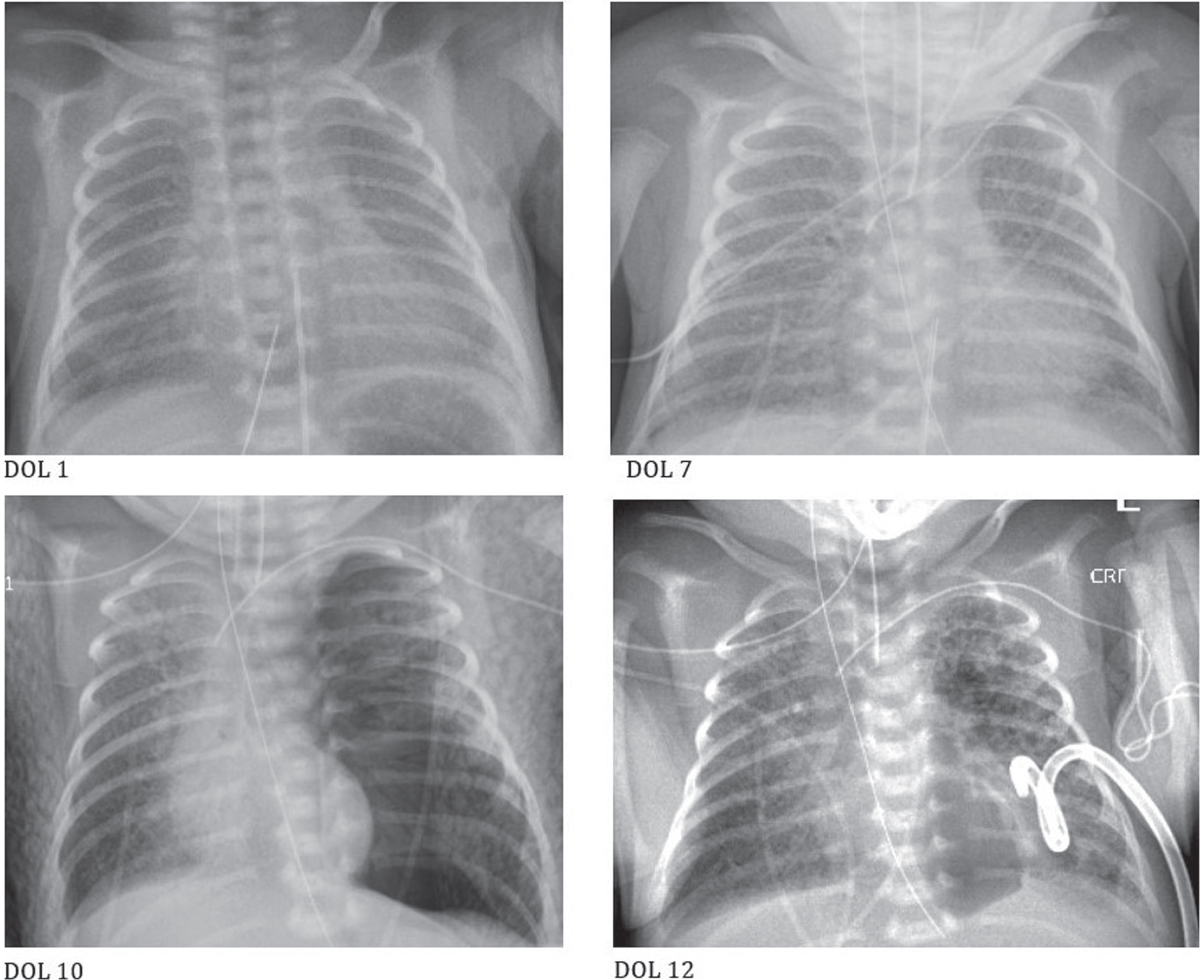 Progression of chest radiographs over first twelve days of life (DOL).