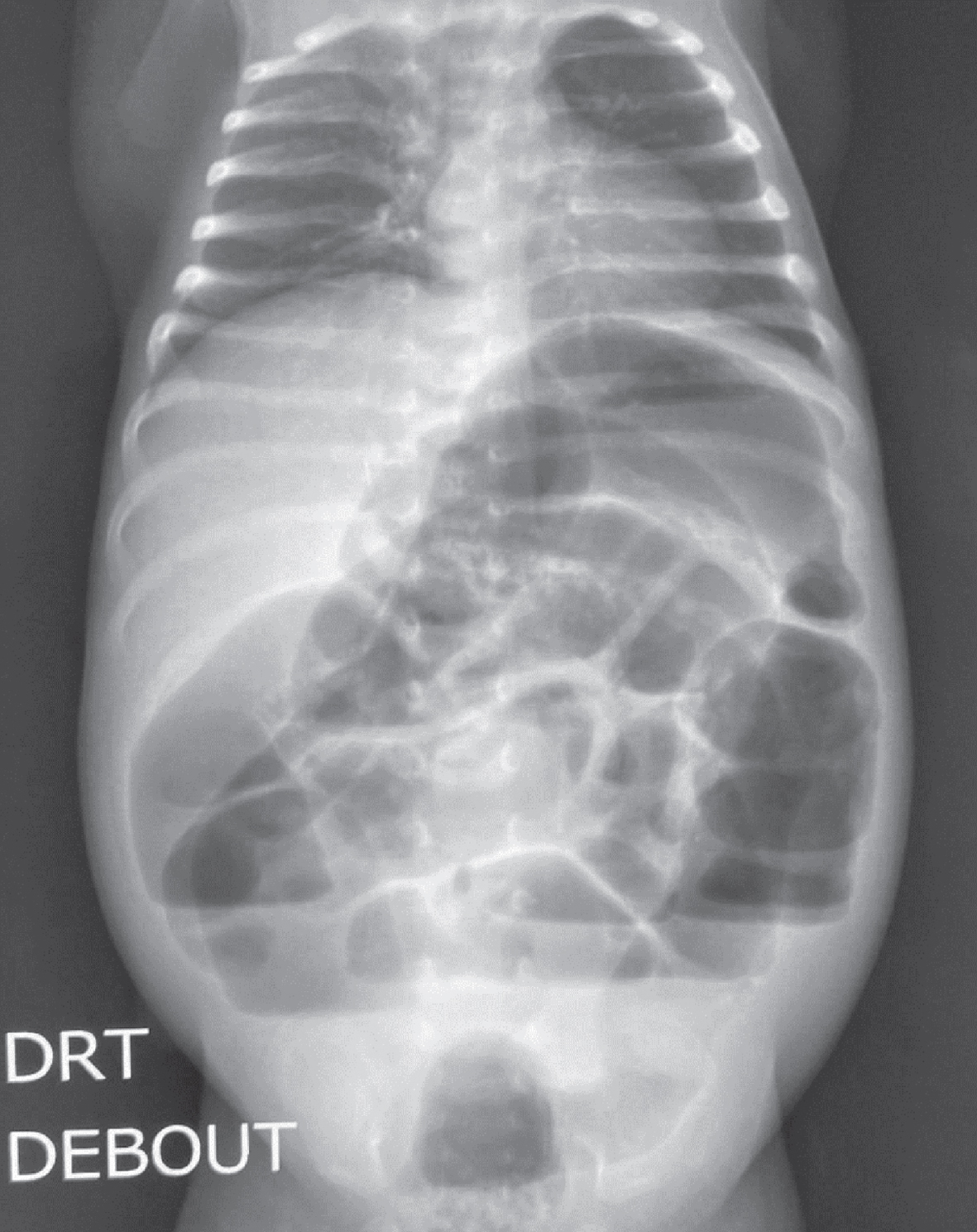 Abdominal radiograph showing distended bowels with air-fluid levels and thickened intestine wall and PI. PI: pneumatosis intestinalis.