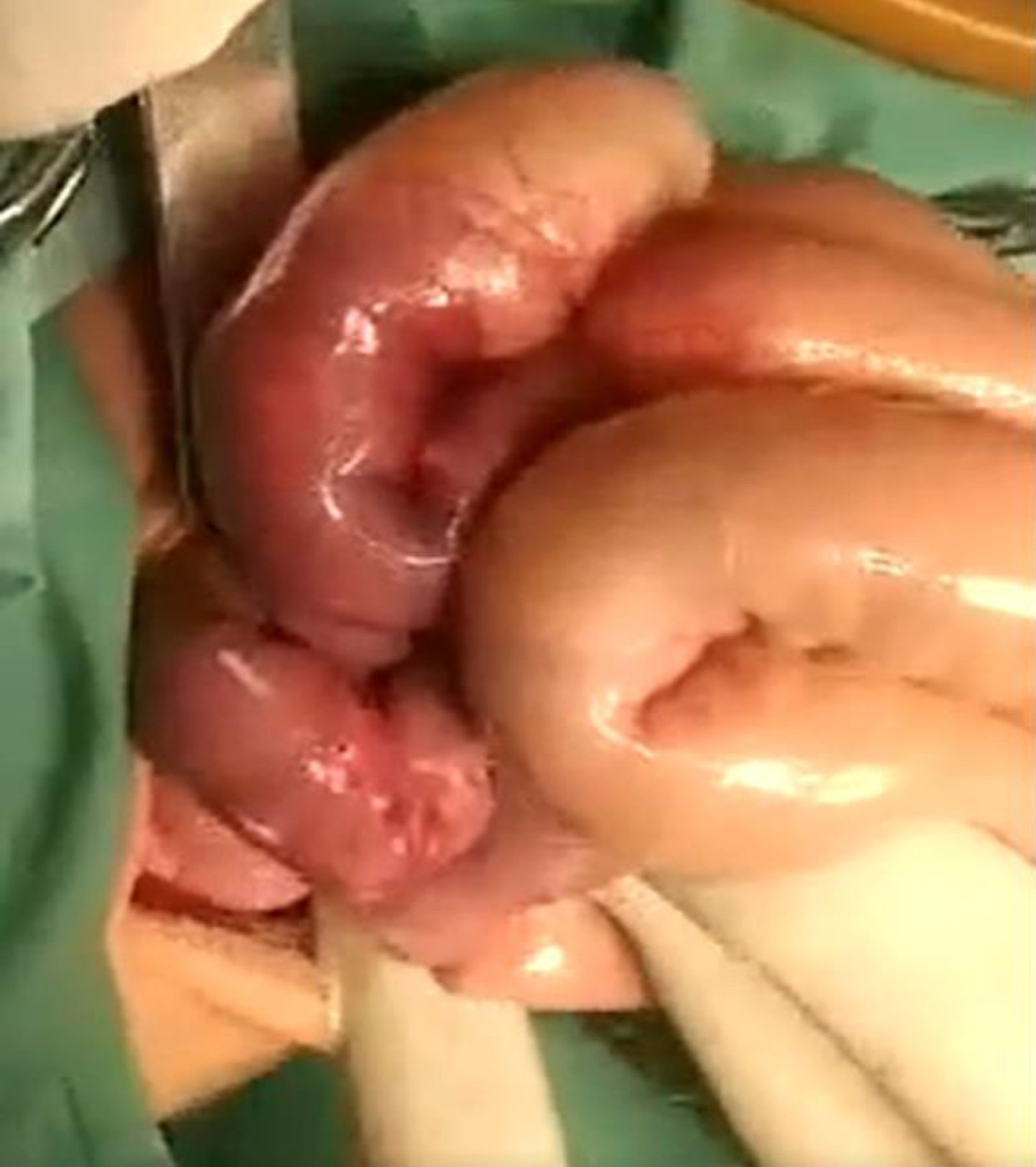 Patient’s intestine on photos during the surgical intervention showing intestinal distension and hyperemia.