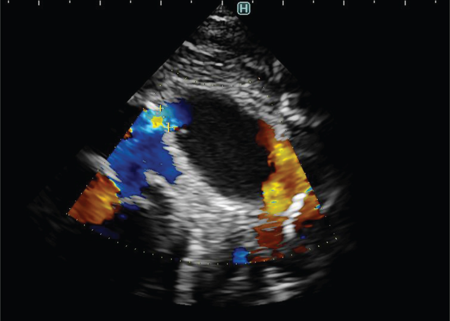 Echocardiogram demonstrating aneurysmal extension of PDA 20×15×14 mm without signs of thrombus in the PDA cavity.