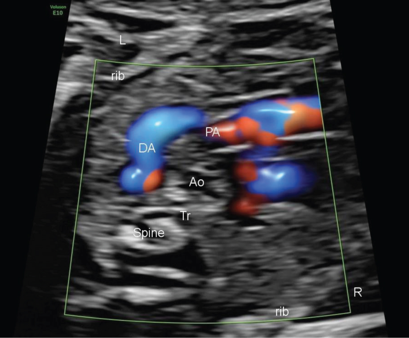 Prenatal ultrasound of the S shaped ductus arteriosus.
