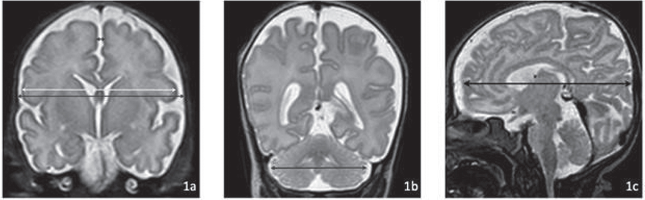 Measurements of (a) cerebral biparietal width (cBPW, light grey), bone biparietal width (bBPW, dark grey), interhemispheric distance (IHD, black); (b) transverse cerebellar diameter (tCD, black) and (c) fronto-occipital diameter (FOD, black).