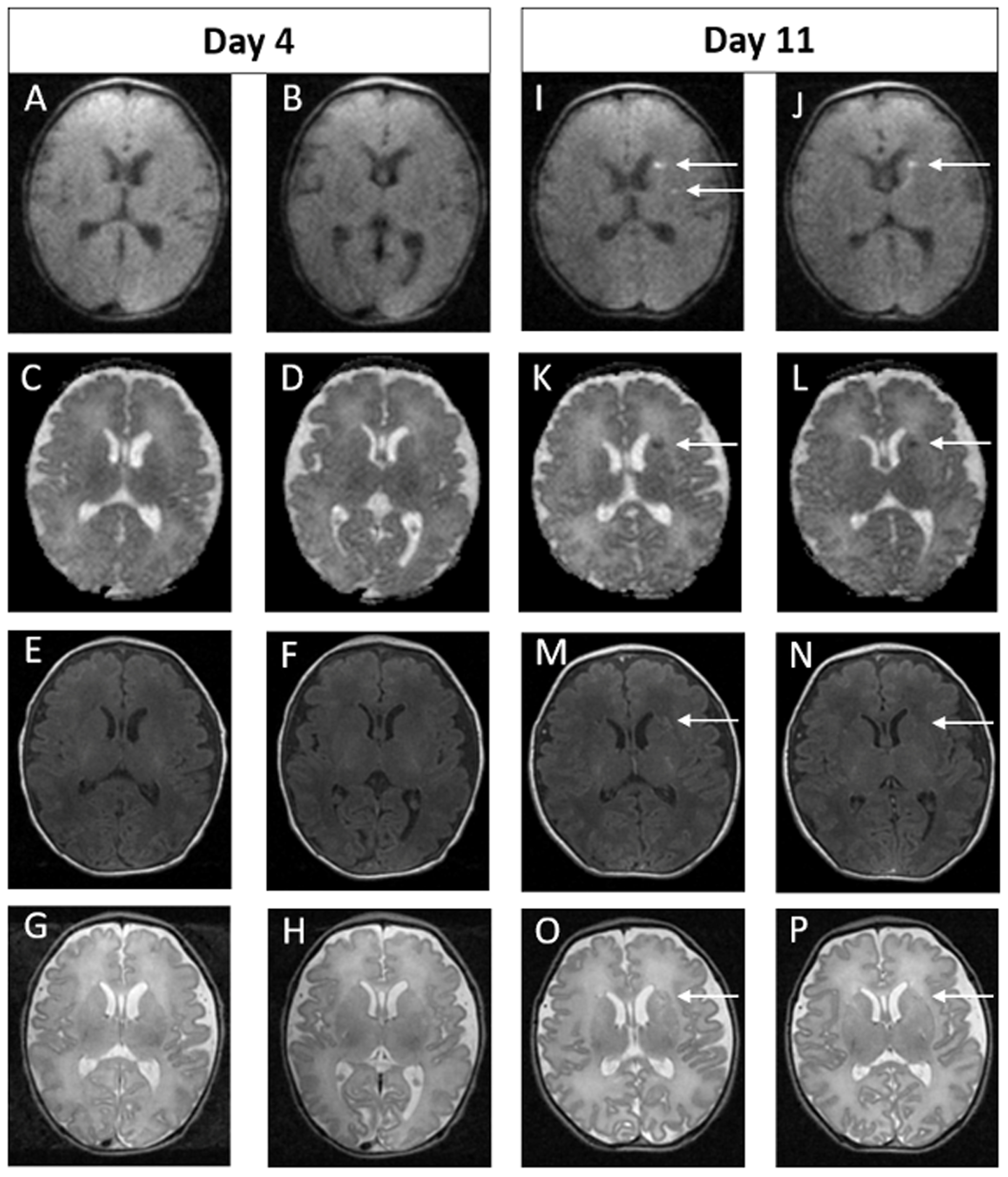 Example of MRI images of normal early scan and abnormal late scan. Images A-H on Day 4. Images I-P on Day 11. In the late scan, punctate foci of diffusion restriction in the left caudate head and left putamen are seen on DWI (I and J) and on ADC (K and L). Punctate foci seen in left external capsule on axial T1 (M and N) and T2 (O and P) weighted images. These findings are not evident on the early scan (A – H).