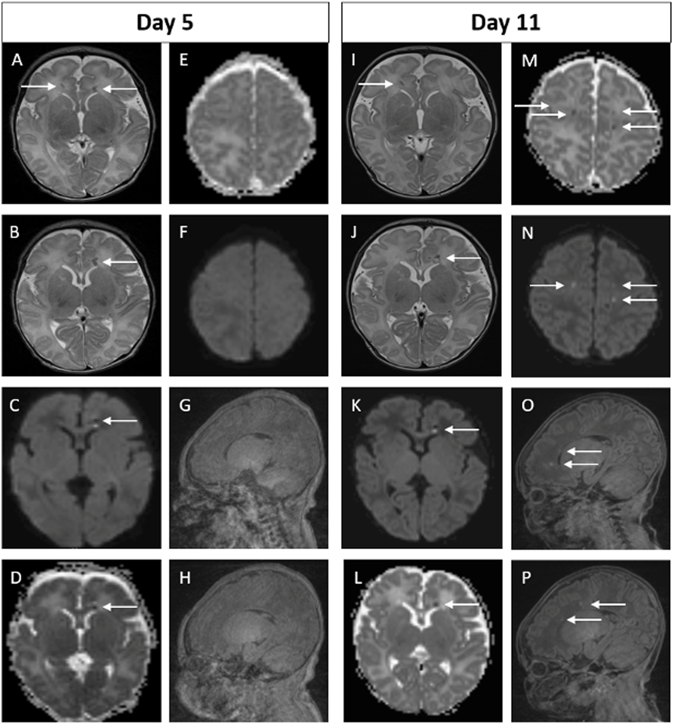 Example of MRI images of abnormal early scan and evolved abnormalities on the late scan. Images A-H on Day 5. Images I-P on Day 11. In the early scan, punctate foci of signal abnormality are seen bilaterally in the frontal periventricular white matter on the axial T2 weighted image (A and B) and on DWI (C and D). These finds are again seen on the late scan (I-L). In addition, new focal punctate white matter lesions are seen on DWI in the deep bilateral frontal white matter of the centra semiovale (M and N) and in the right and left frontal periventricular white matter on sagittal T1 weighted images (O and P). These findings were not evident on the early scan (E-H).