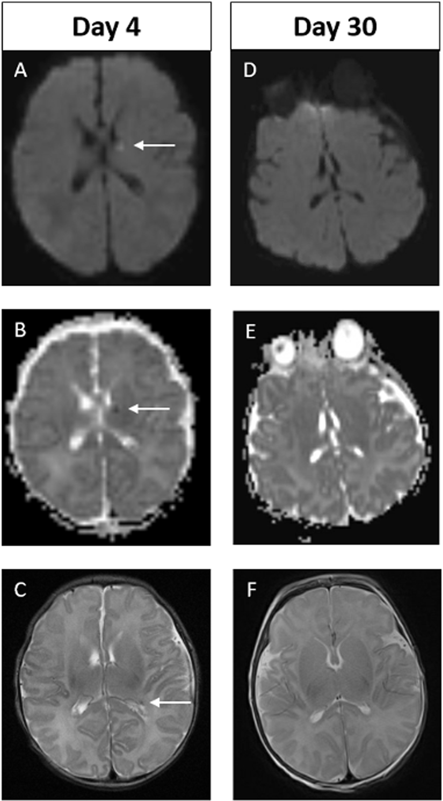 Example of MRI images of abnormal early scan and normal late scan. Images A-C on Day 4. Images D-F on Day 30. In the early scan, punctate focus of diffusion restriction in the anterior, superior aspect of left thalamus is seen on DWI (A) and on ADC (B). Punctate focus of low signal intensity at left lateral ventricular atrium seen on axial T2 weighted image (C). These findings are not evident on the late scan (D-F). Of note, there are technical differences in alignment between the two scans.