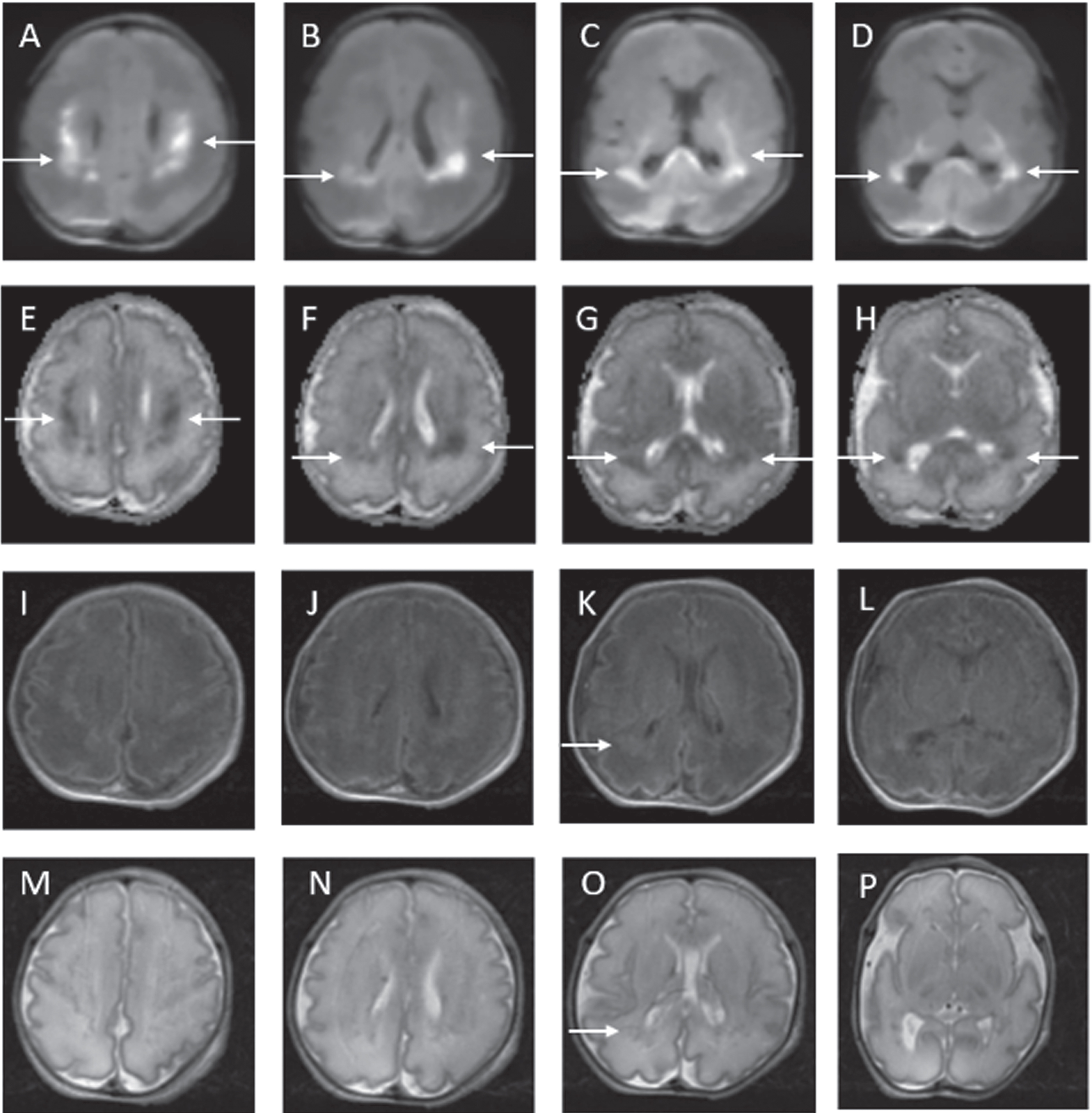MRI findings on postnatal day 2. DWI abnormalities are depicted from A to D. Apparent diffusion coefficient (ADC) abnormalities are depicted from E to H. White matter abnormalities are in the classic distribution for PVL. Minimal abnormalities seen on conventional axial T1 (I to L) and axial T2 (M to P) weighted images.