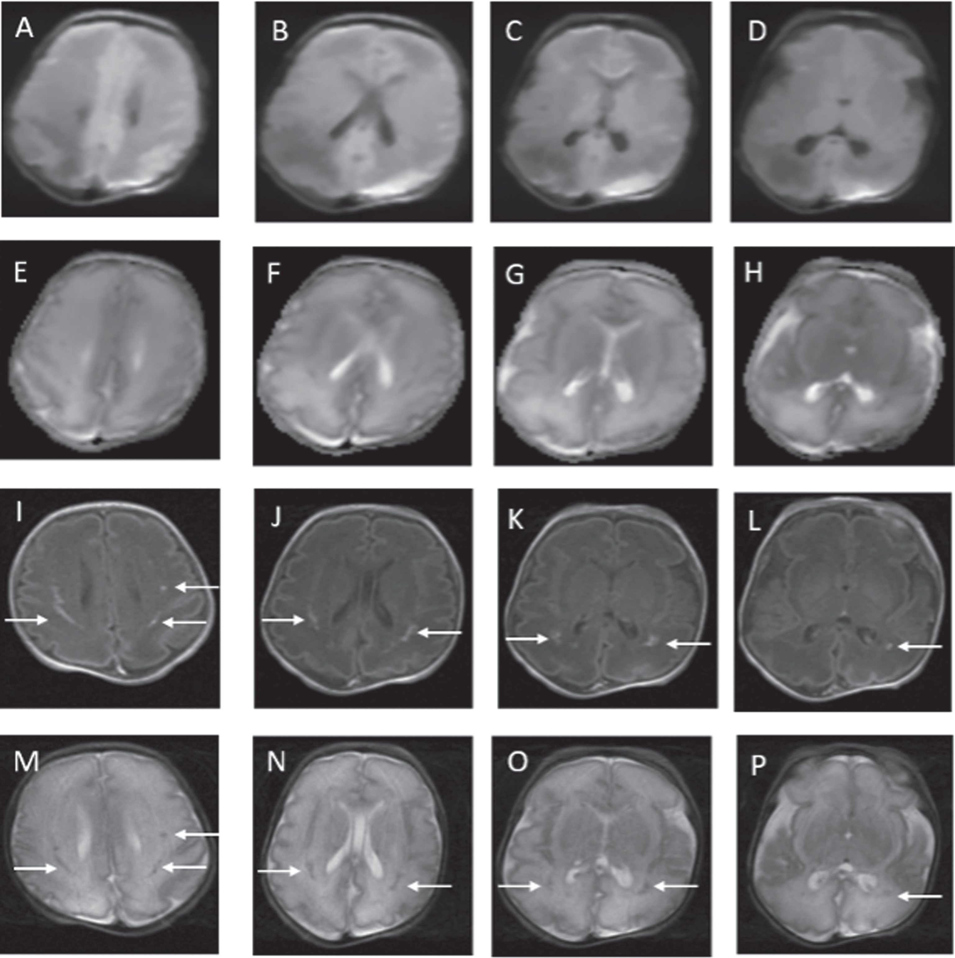 MRI findings on postnatal day 12. Previously seen abnormalities on DWI and ADC have resolved (A to H). White matter injury now more evident on axial T1 (I to L) and axial T2 (M to P) images.