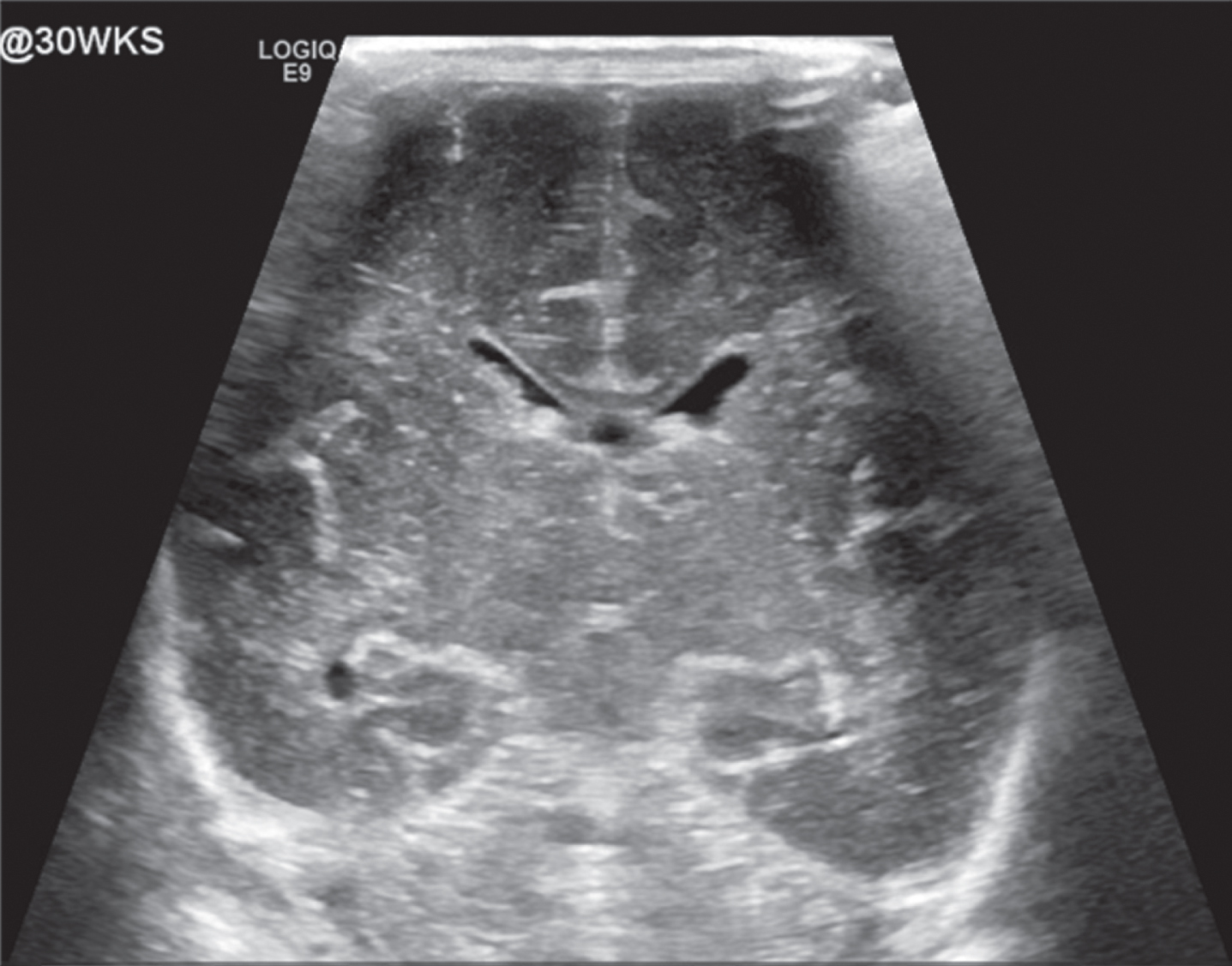 Normal appearing head ultrasound of a 30 week GA newborn at 7 days of life
