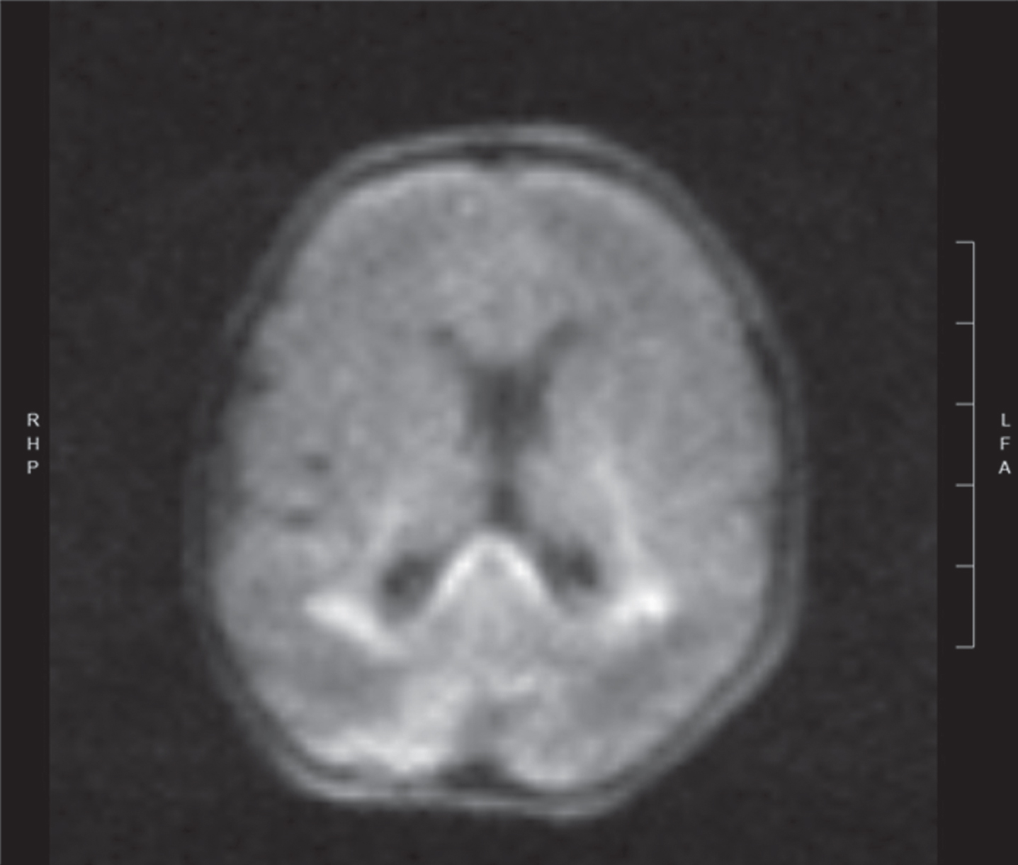 Diffusion weighted image of same newborn at day 3 of life showing areas of acute white matter injury with restricted diffusion