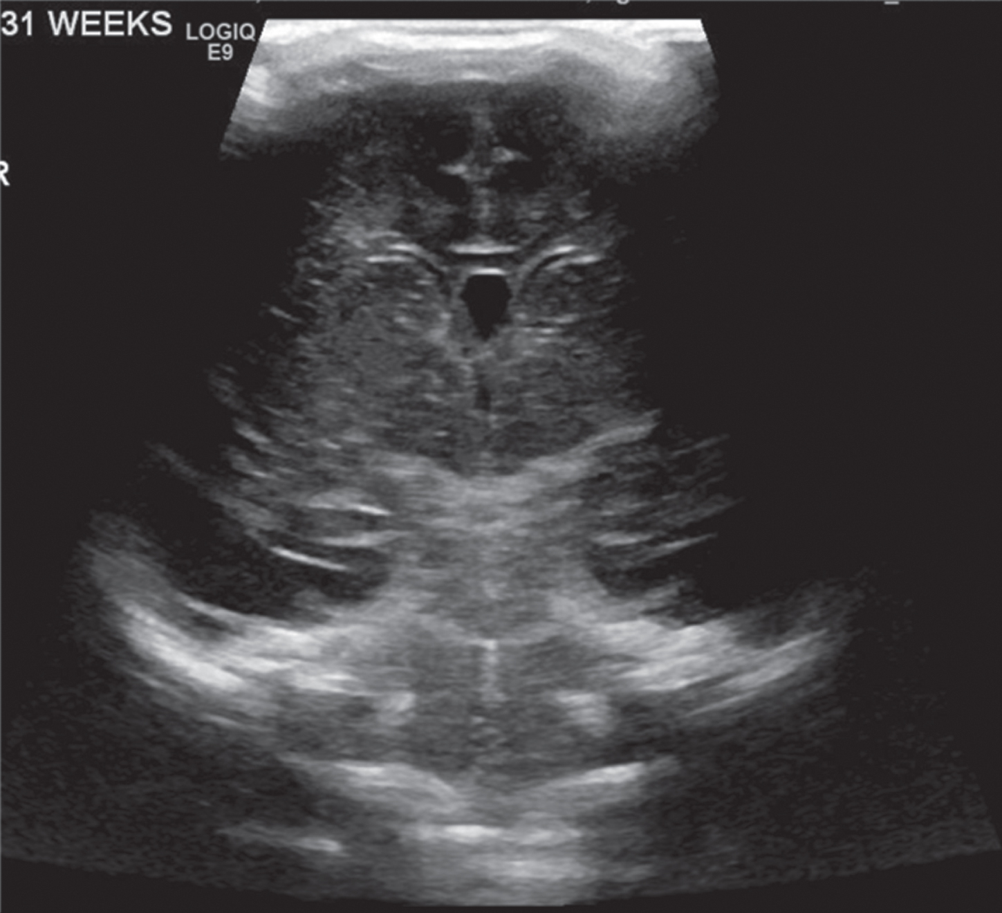 Normal appearing head ultrasound of a 31 week GA newborn at 4 days of life