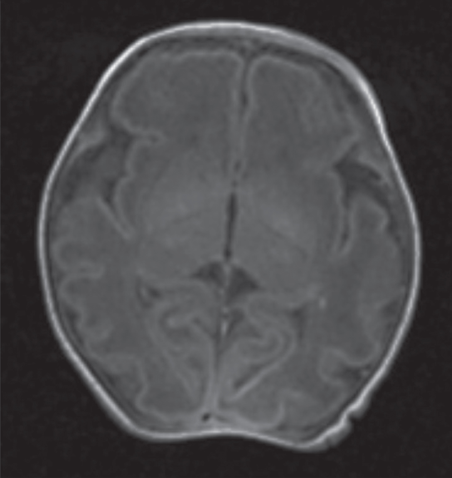 Axial T1 image of same baby at day 5 showing area of gliosis in left parietal lobe