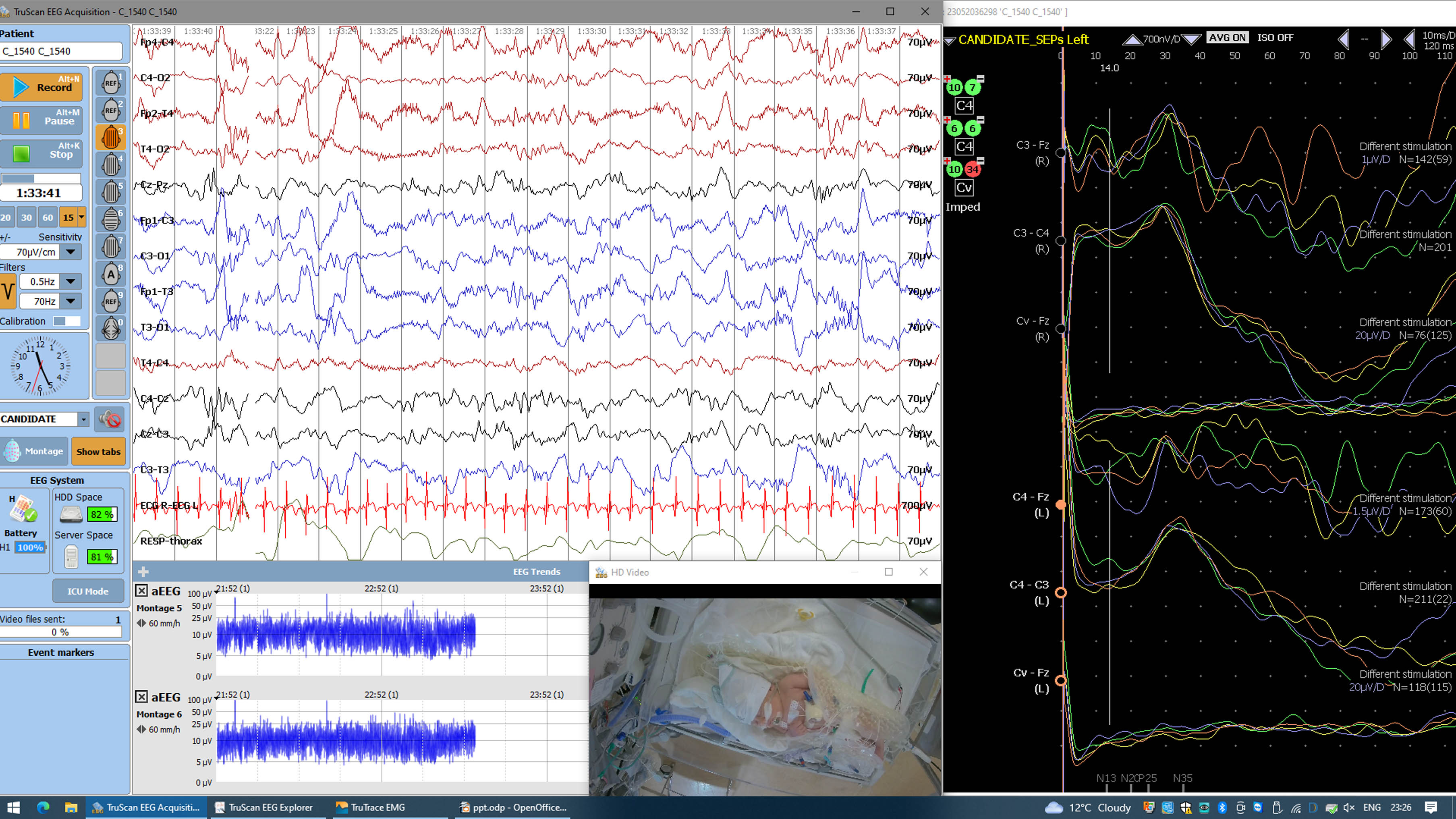 Multimodal neurophysiological monitoring in the NICU, with video-EEG, aEEG, and simultaneously recorded SEPs.