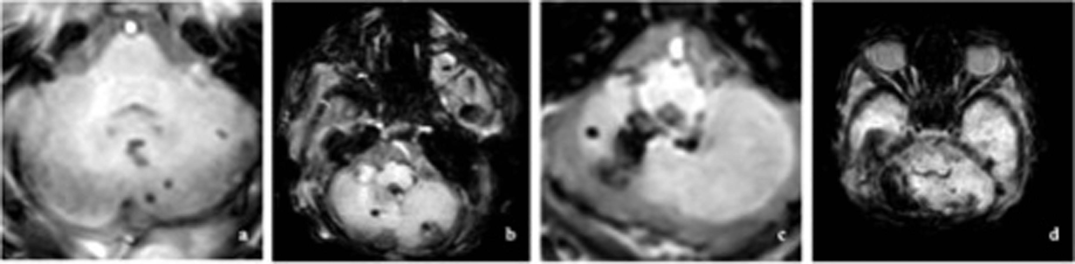 Classification of cerebellar hemorrhage, with a unilateral punctate lesions (≤3 mm); b bilateral punctate lesions (≤3 mm); c unilateral extensive hemorrhage (>3 mm); d bilateral extensive hemorrhage (>3 mm).