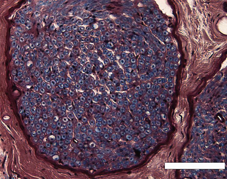 A low-power view of the inferior alveolar nerve from a 78-year-old man, modified luxol fast blue-periodic acid Schiff-hematoxylin triple stain. Scale bar = 100 μm.