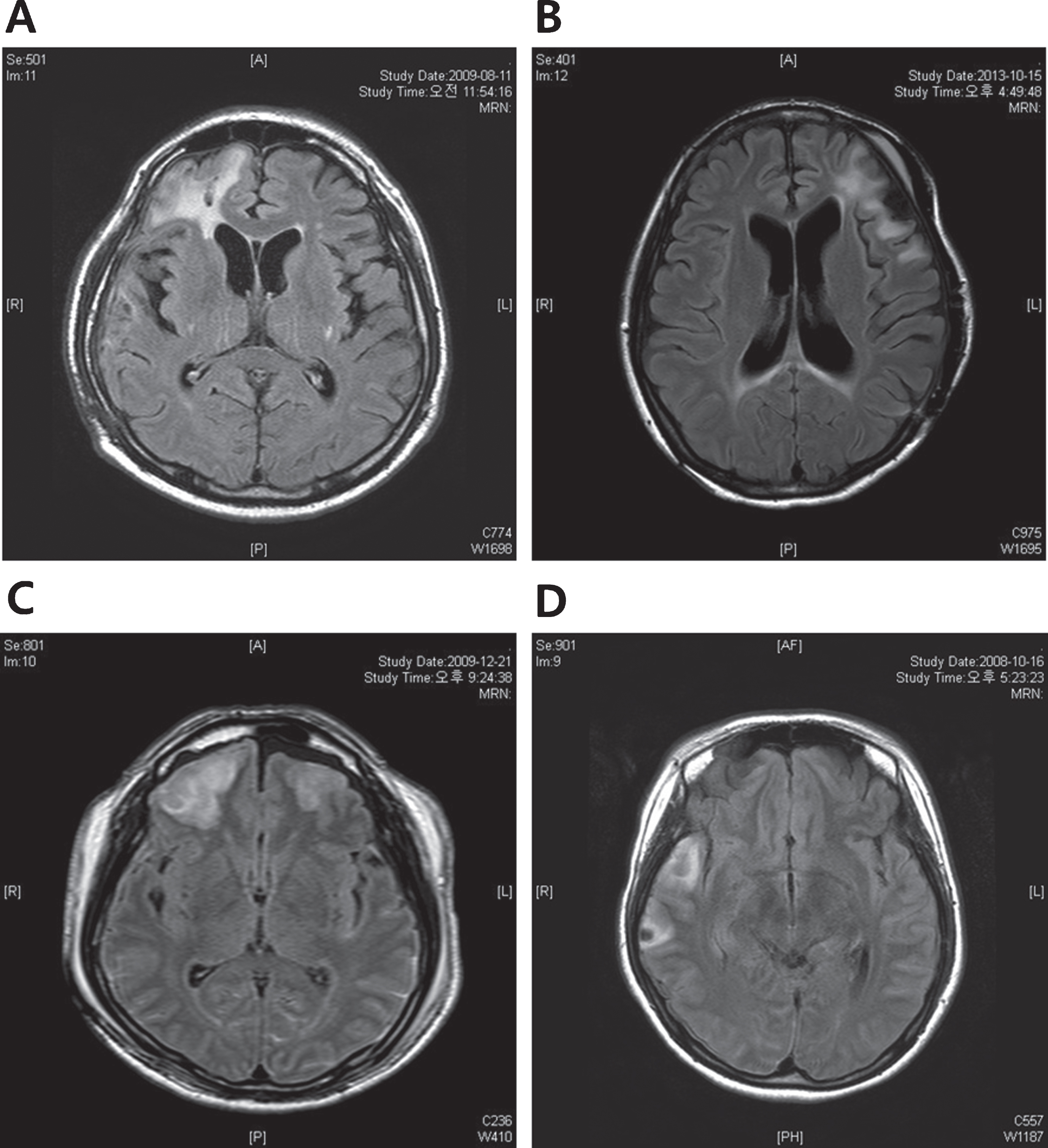 The representative MRI images of each TBI group. (A) Right frontal injury (B) Left frontal injury (C) Bilateral frontal injury (D) Non-frontal injury, Right temporal injury. MRI, Magnetic Resonance Imaging; TBI, Traumatic brain injury.