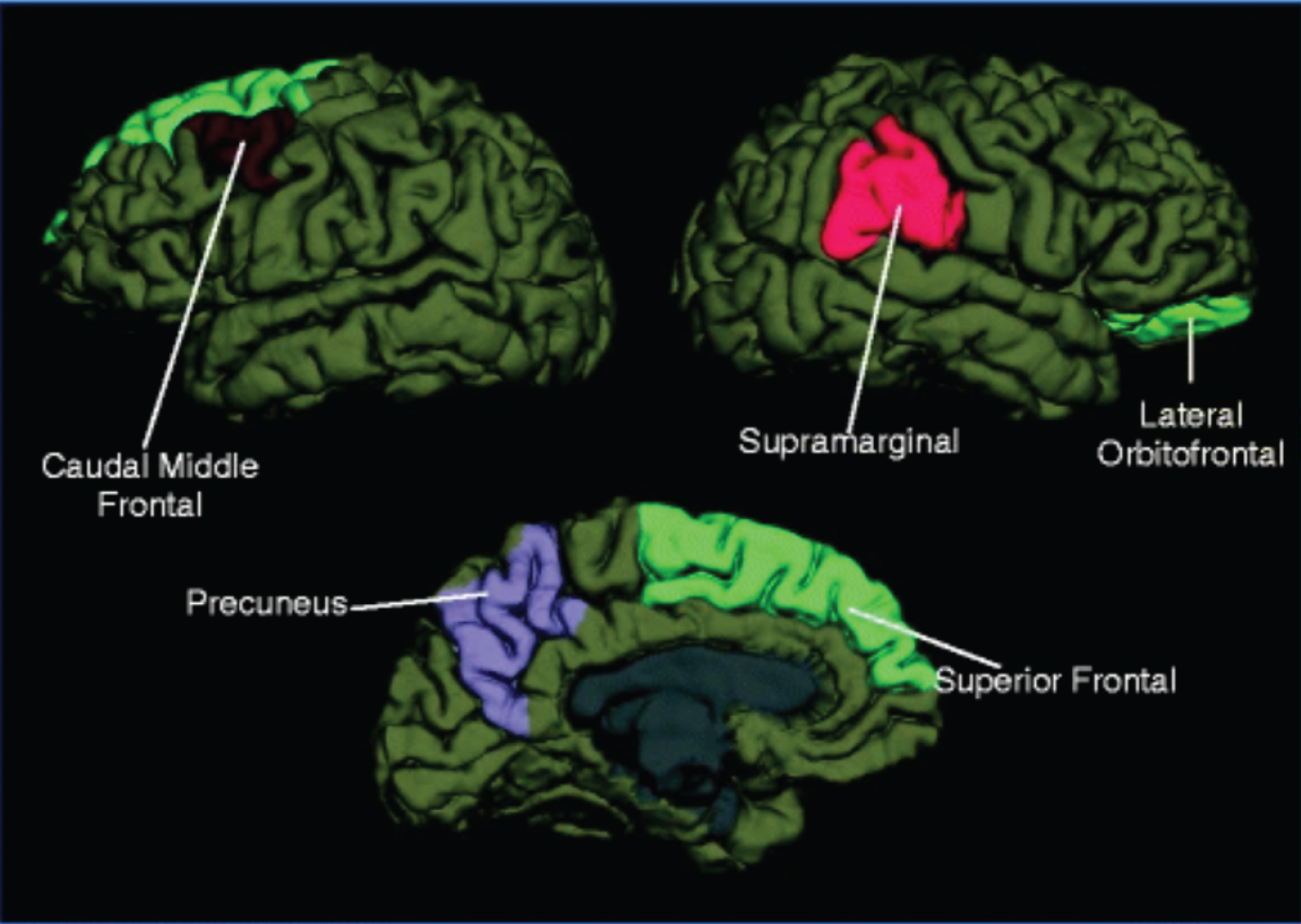 Regions with structural differences when comparing individuals with persistent post-traumatic cephalalgia (PPTC) to those with migraine. When comparing structural measurements of entire brain regions in patients with PPTC to patients with migraine, the right lateral orbital frontal region differed in area, volume, and curvature. The left caudal middle frontal, precuneus, and superior frontal regions and the right supramarginal gyrus region differed in cortical thickness (Schwedt et al., 2017).